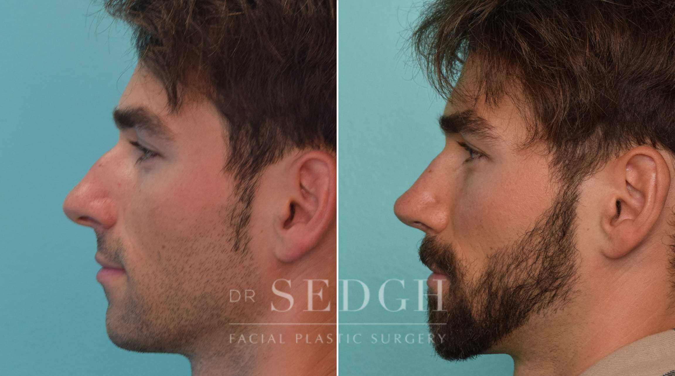 patient before and after rhinoplasty procedure