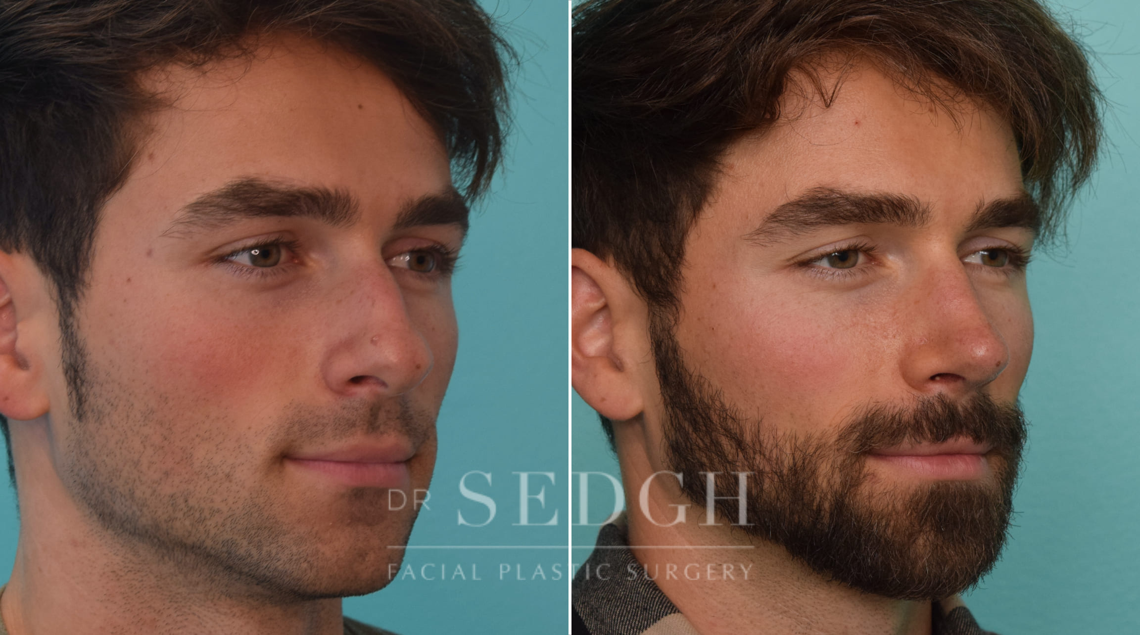 patient before and after rhinoplasty procedure