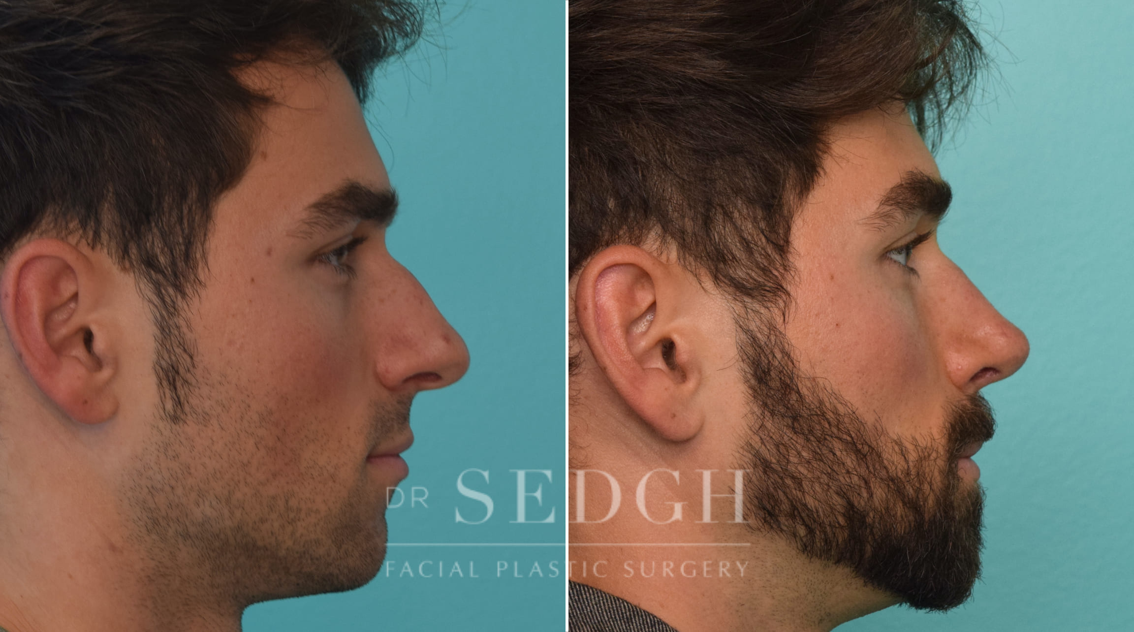 patient before and after rhinoplasty procedure