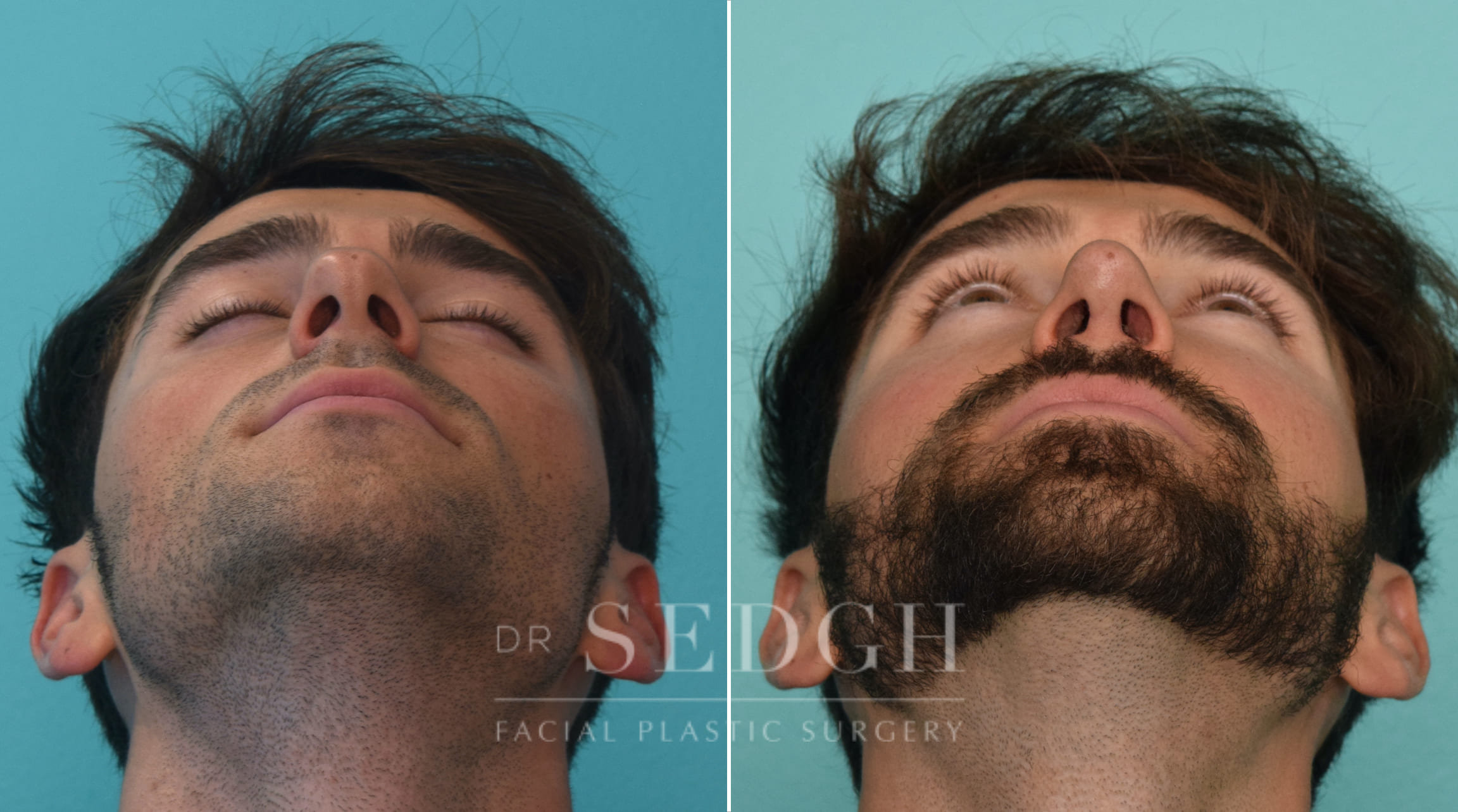 patient before and after rhinoplasty procedure