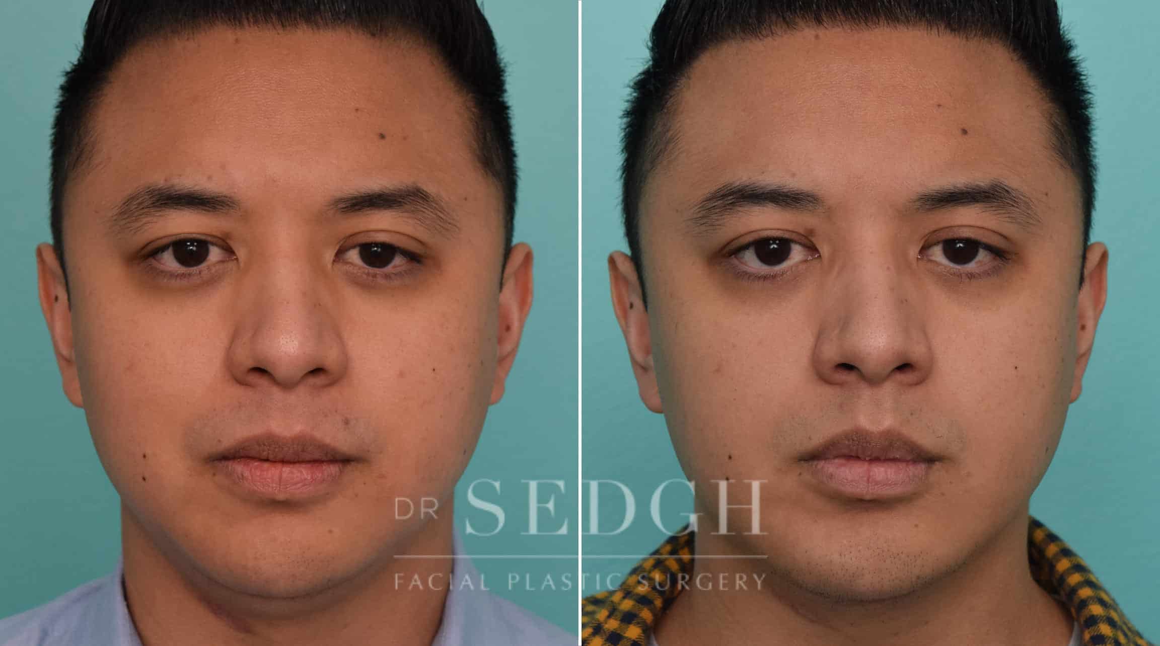 patient before and after chin augmentation and neck lipo procedure | Sedgh