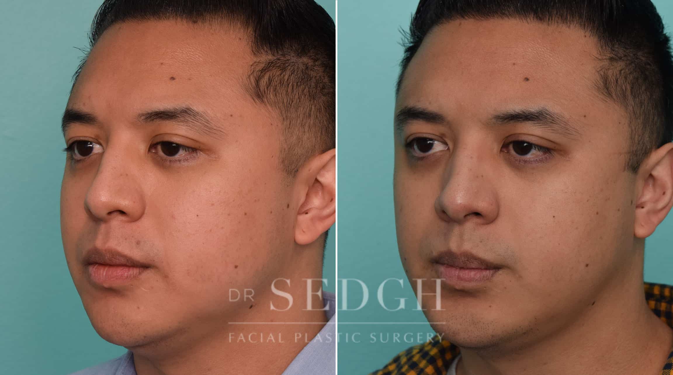 patient before and after chin augmentation and neck lipo procedure | Sedgh