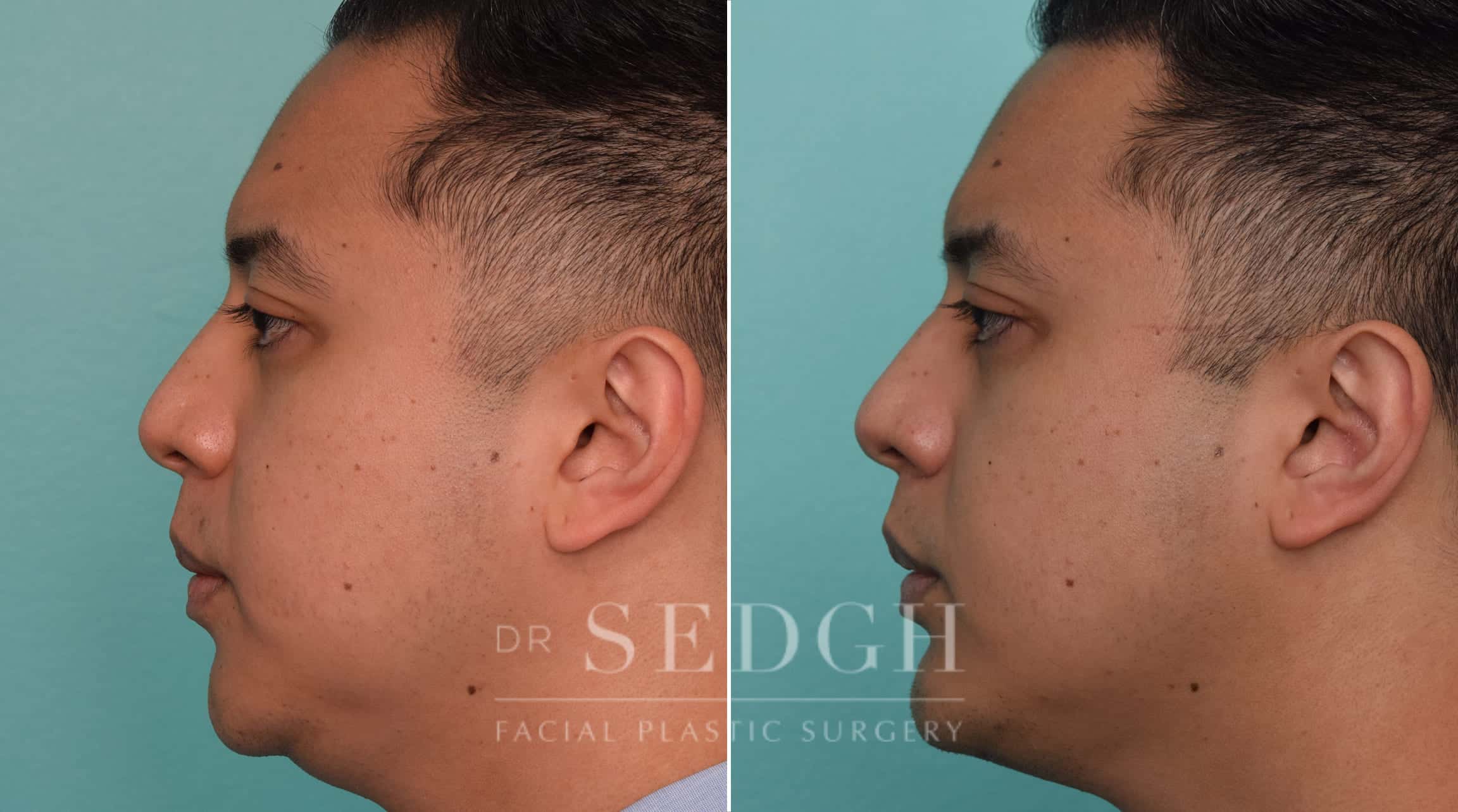 patient before and after chin augmentation and neck lipo procedure | Sedgh