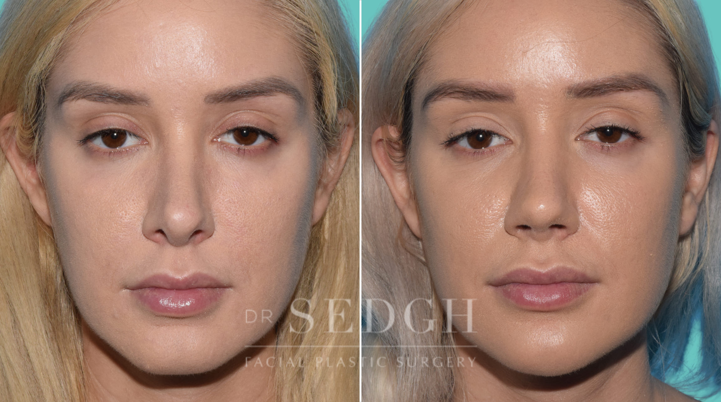 patient before and after revision rhinoplasty procedure