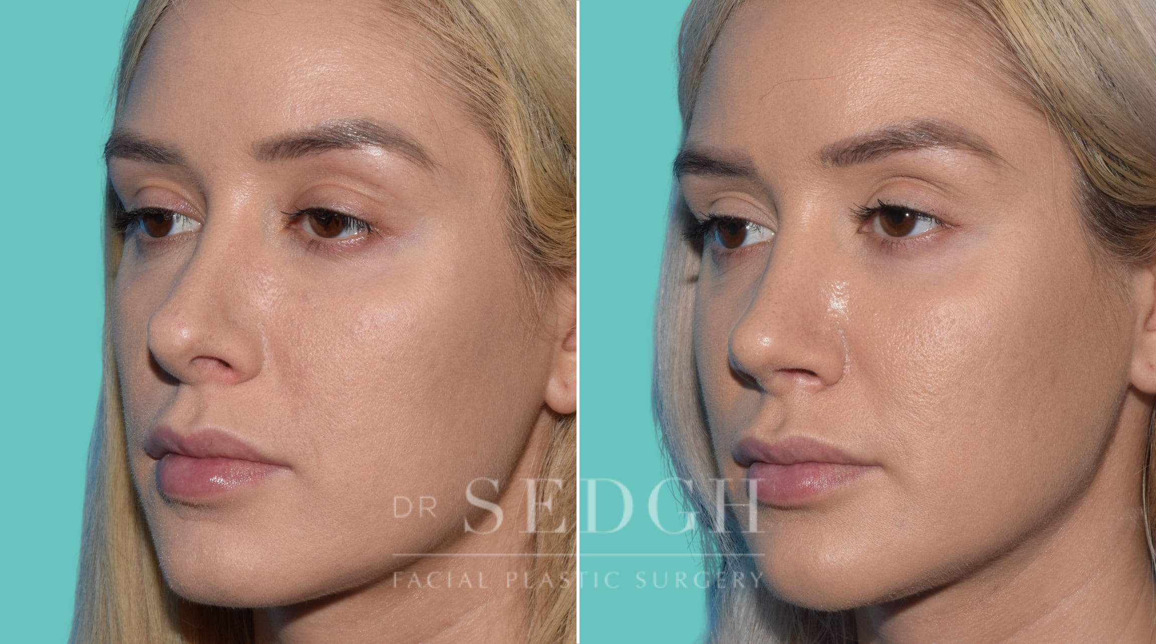 patient before and after revision rhinoplasty procedure