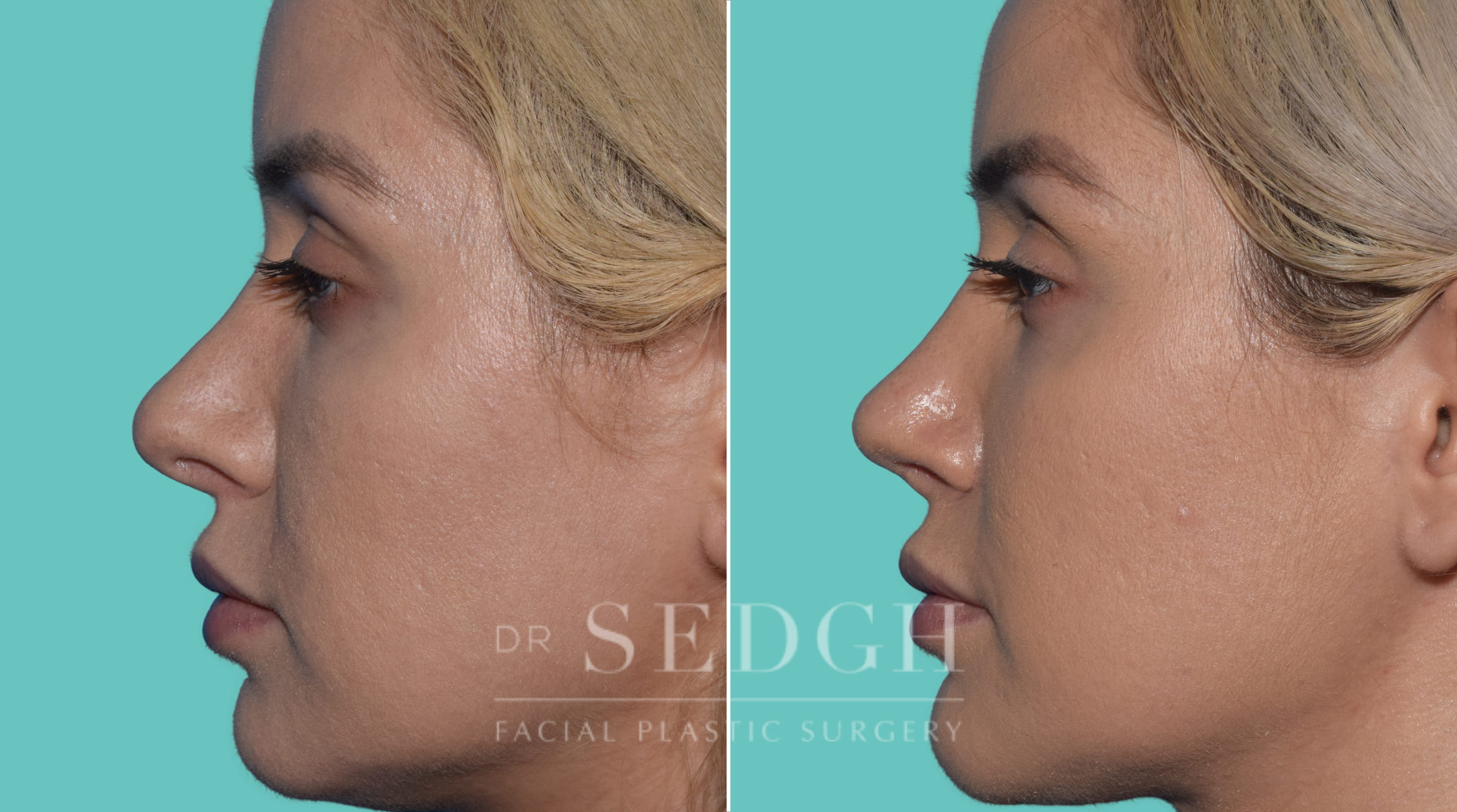 patient before and after revision rhinoplasty procedure