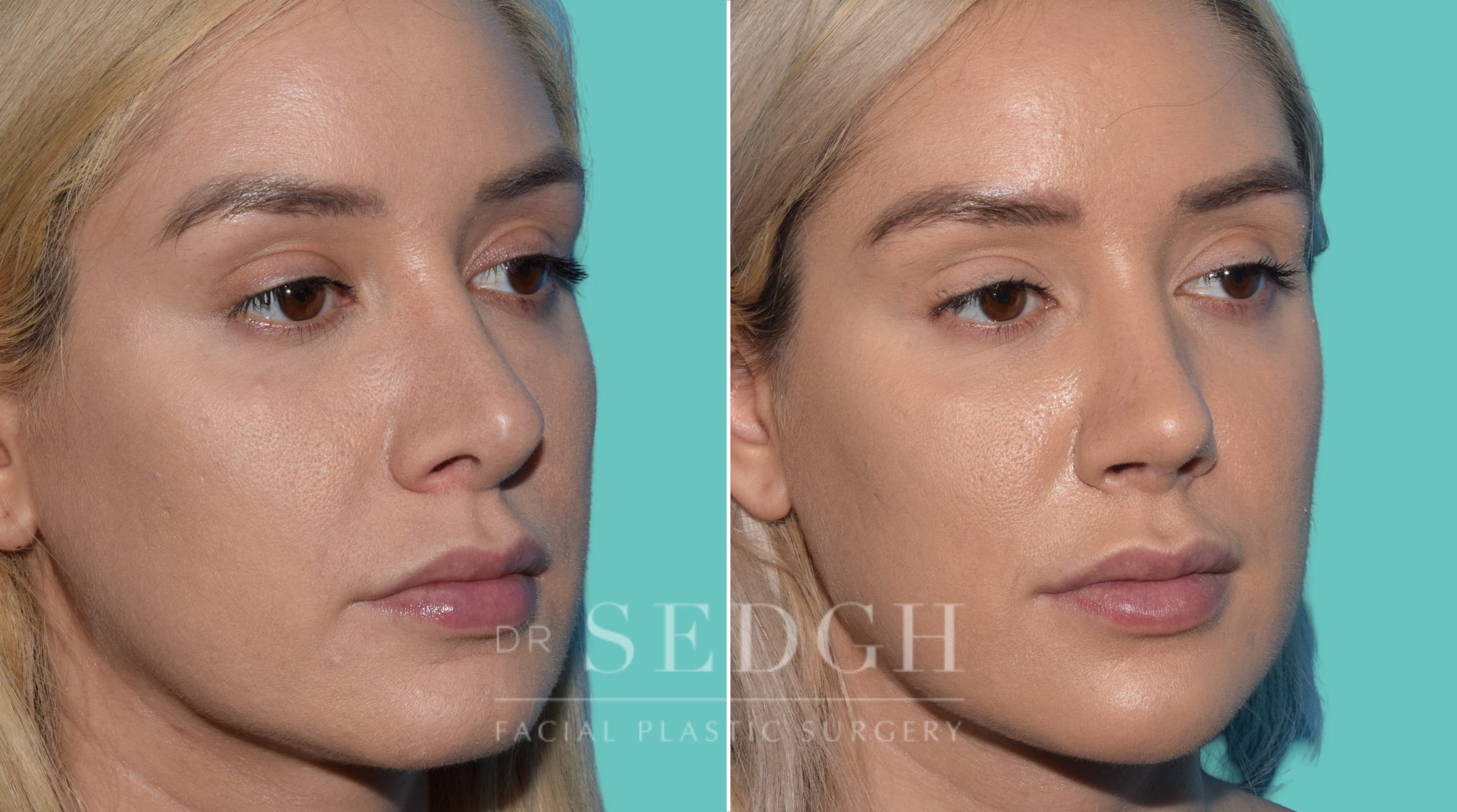 patient before and after revision rhinoplasty procedure