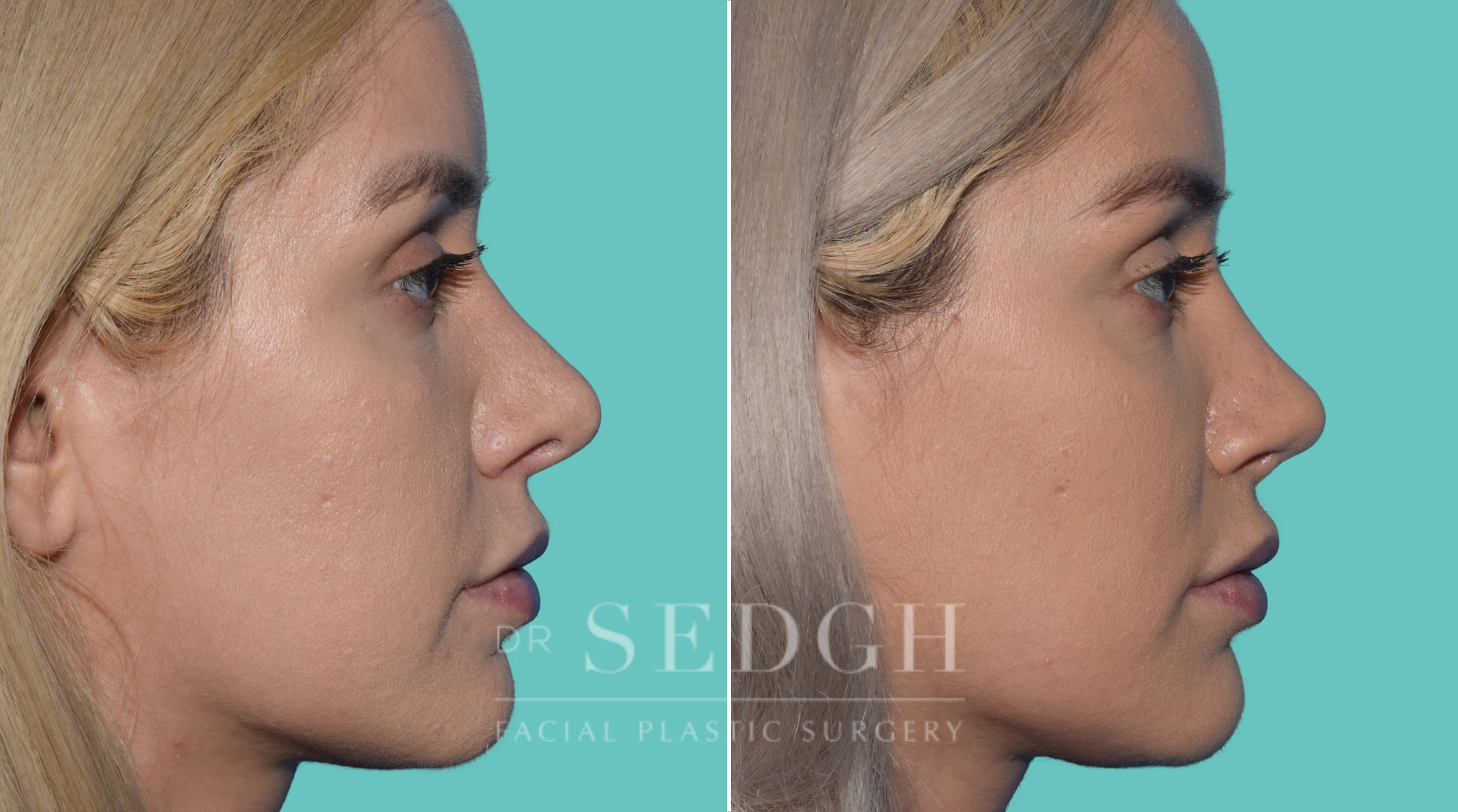 patient before and after revision rhinoplasty procedure