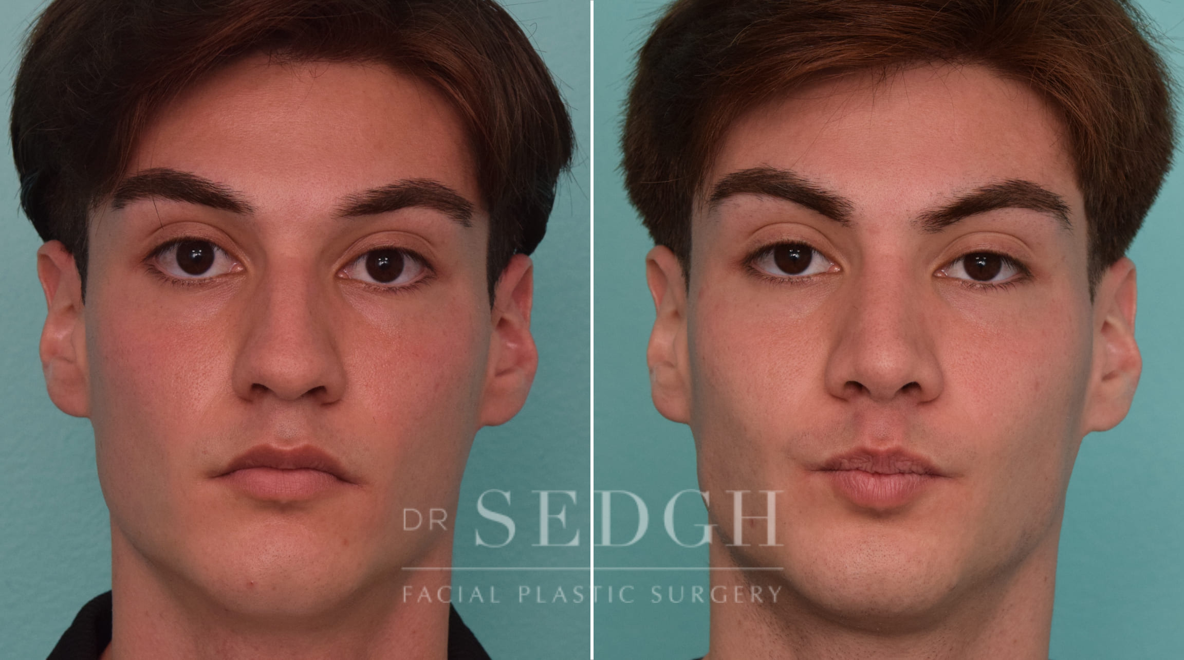 patient before and after rhinoplasty procedure