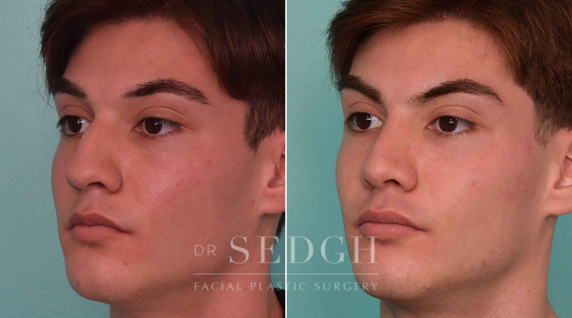 patient before and after rhinoplasty procedure