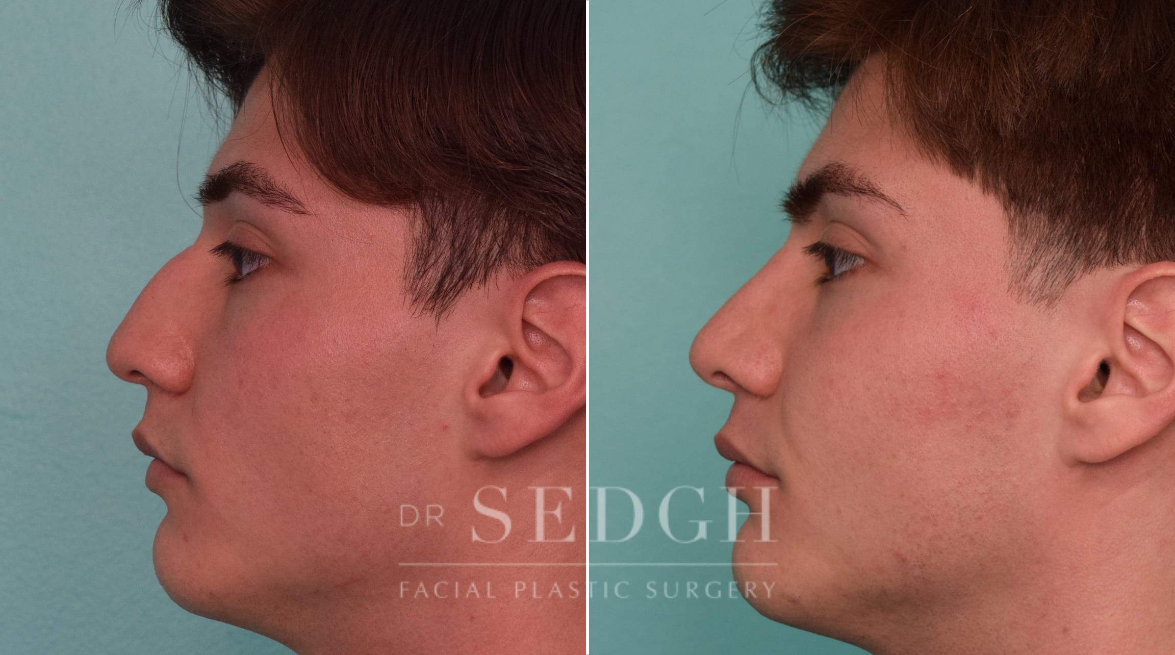 patient before and after rhinoplasty procedure