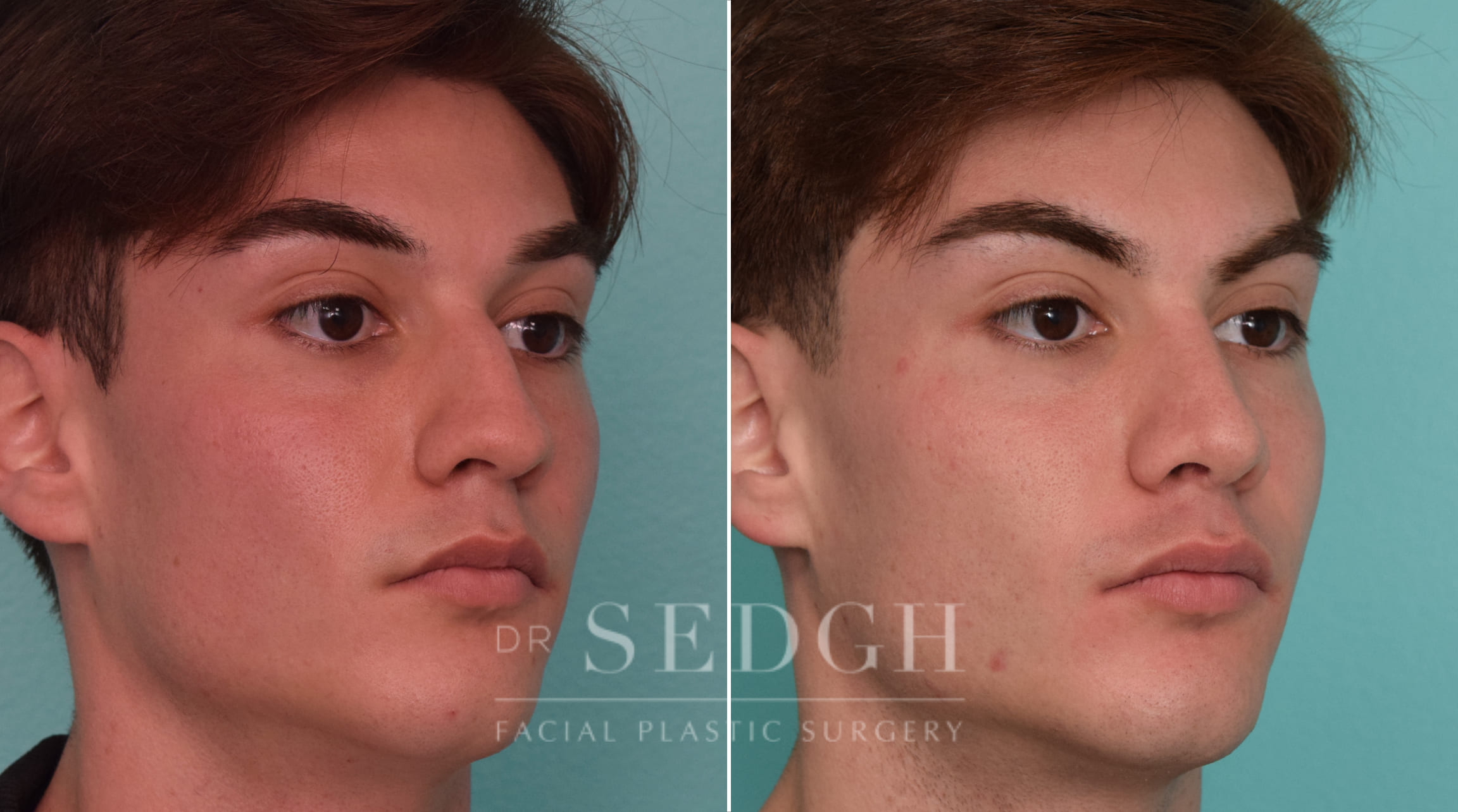 patient before and after rhinoplasty procedure