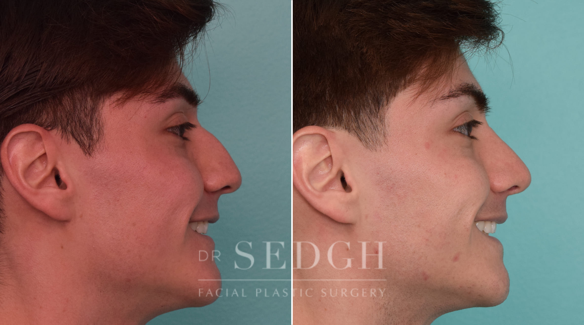 patient before and after rhinoplasty procedure