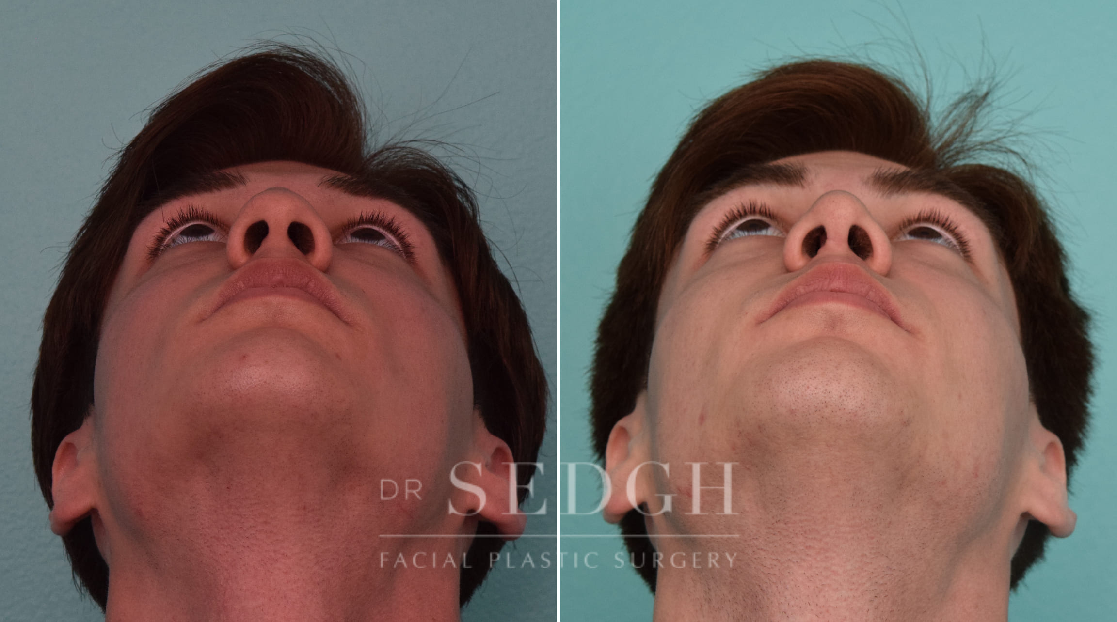 patient before and after rhinoplasty procedure