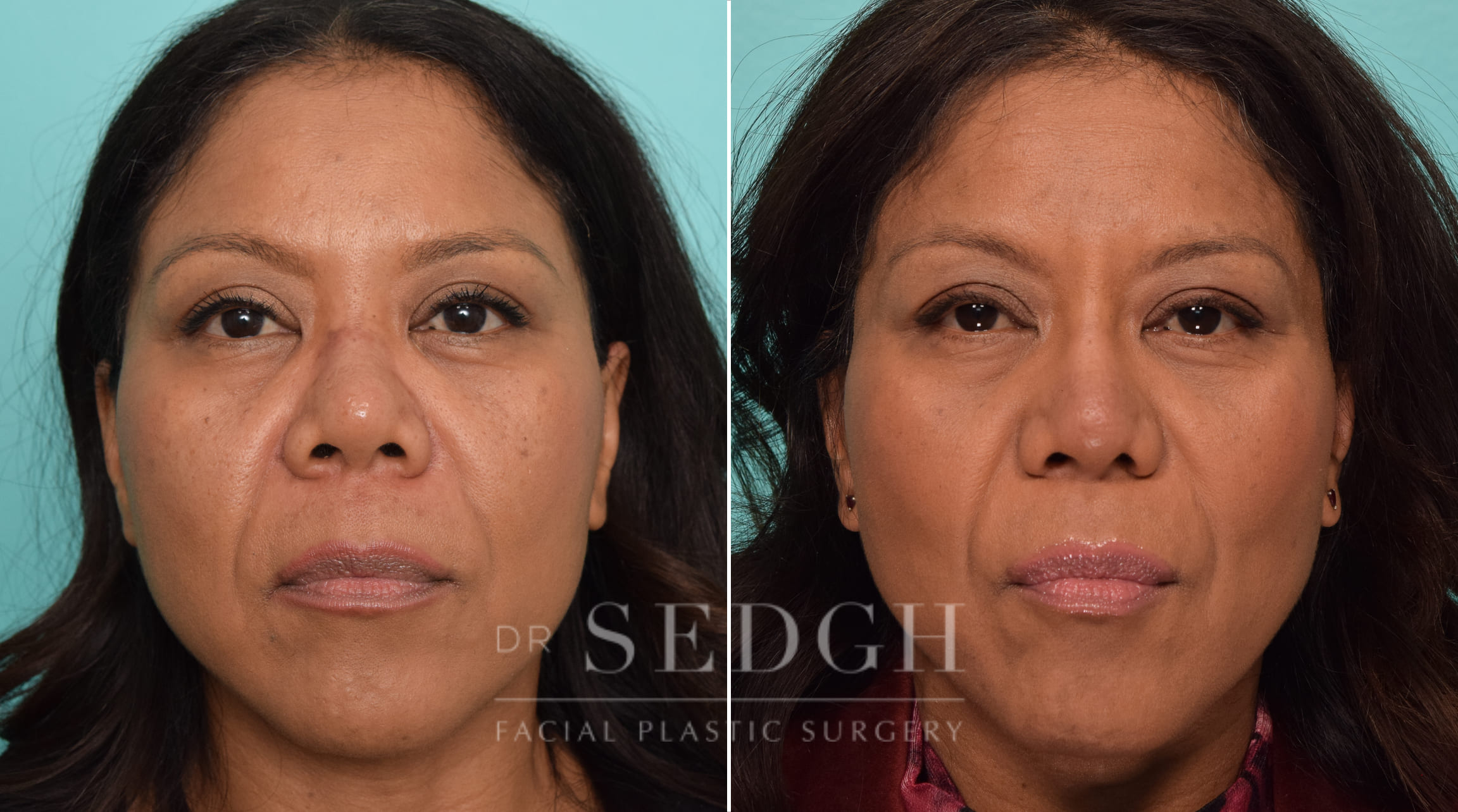 female patient before and after rhinoplasty | Sedgh