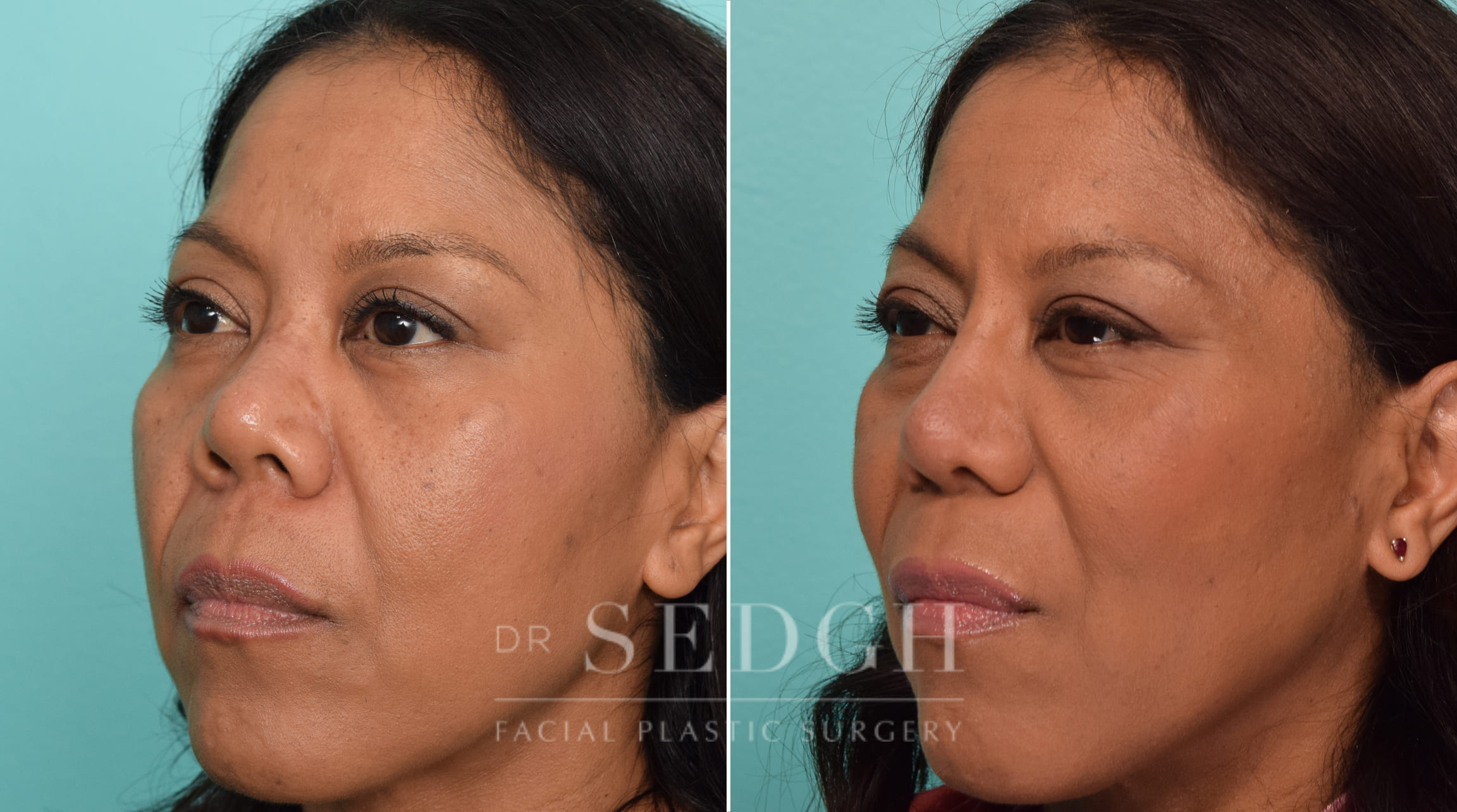 female patient before and after rhinoplasty | Sedgh