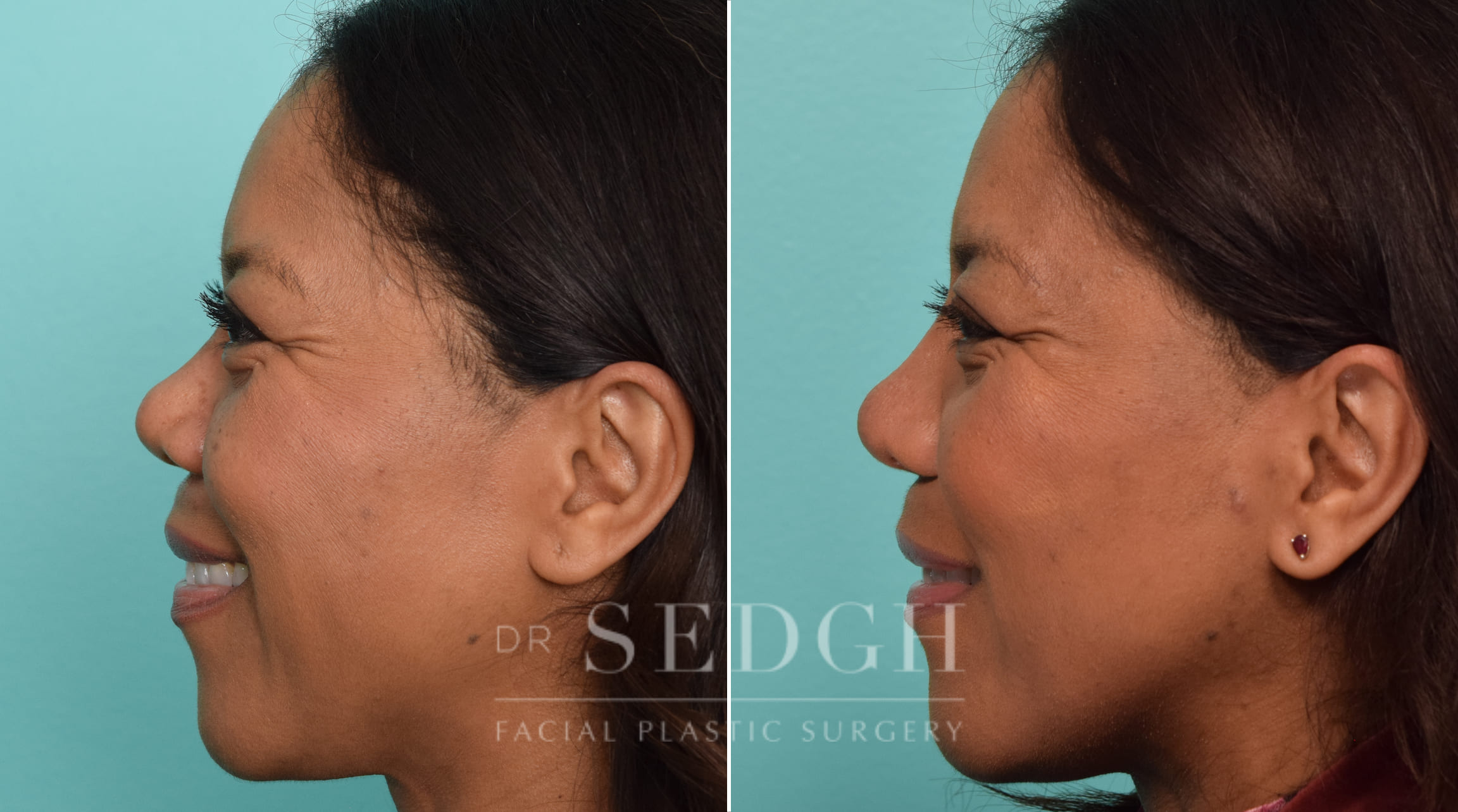 female patient before and after rhinoplasty | Sedgh