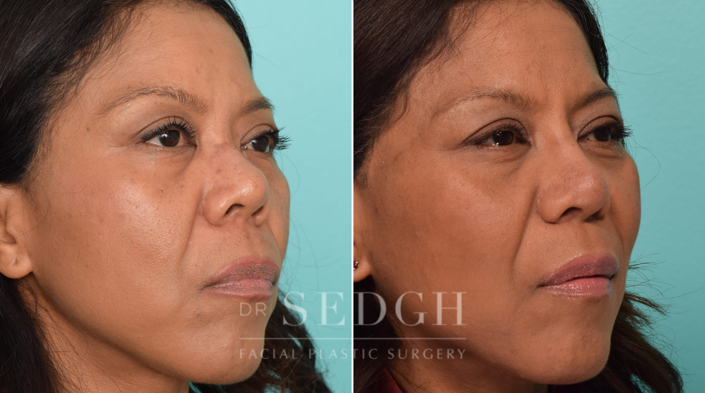 female patient before and after rhinoplasty | Sedgh