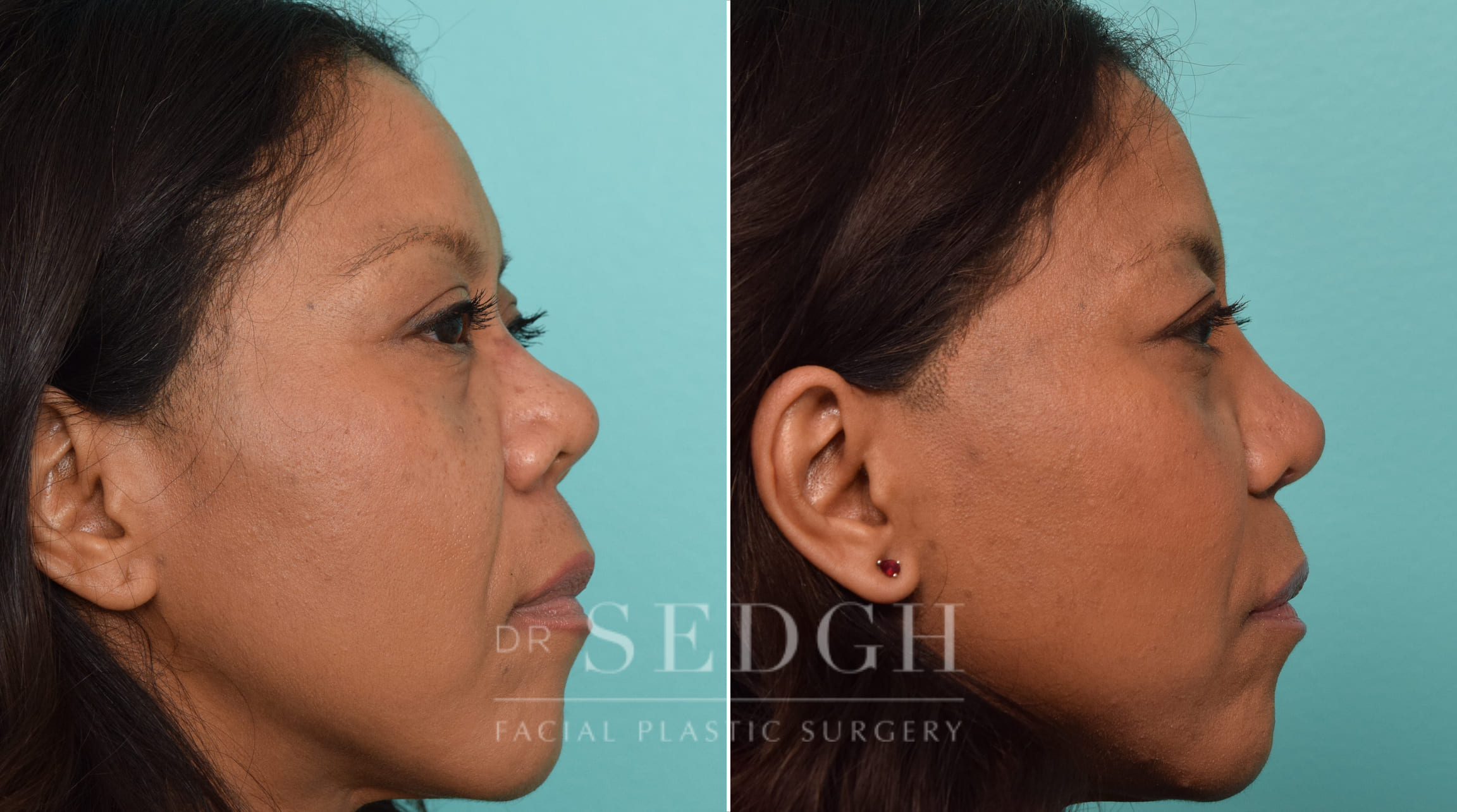 female patient before and after rhinoplasty | Sedgh