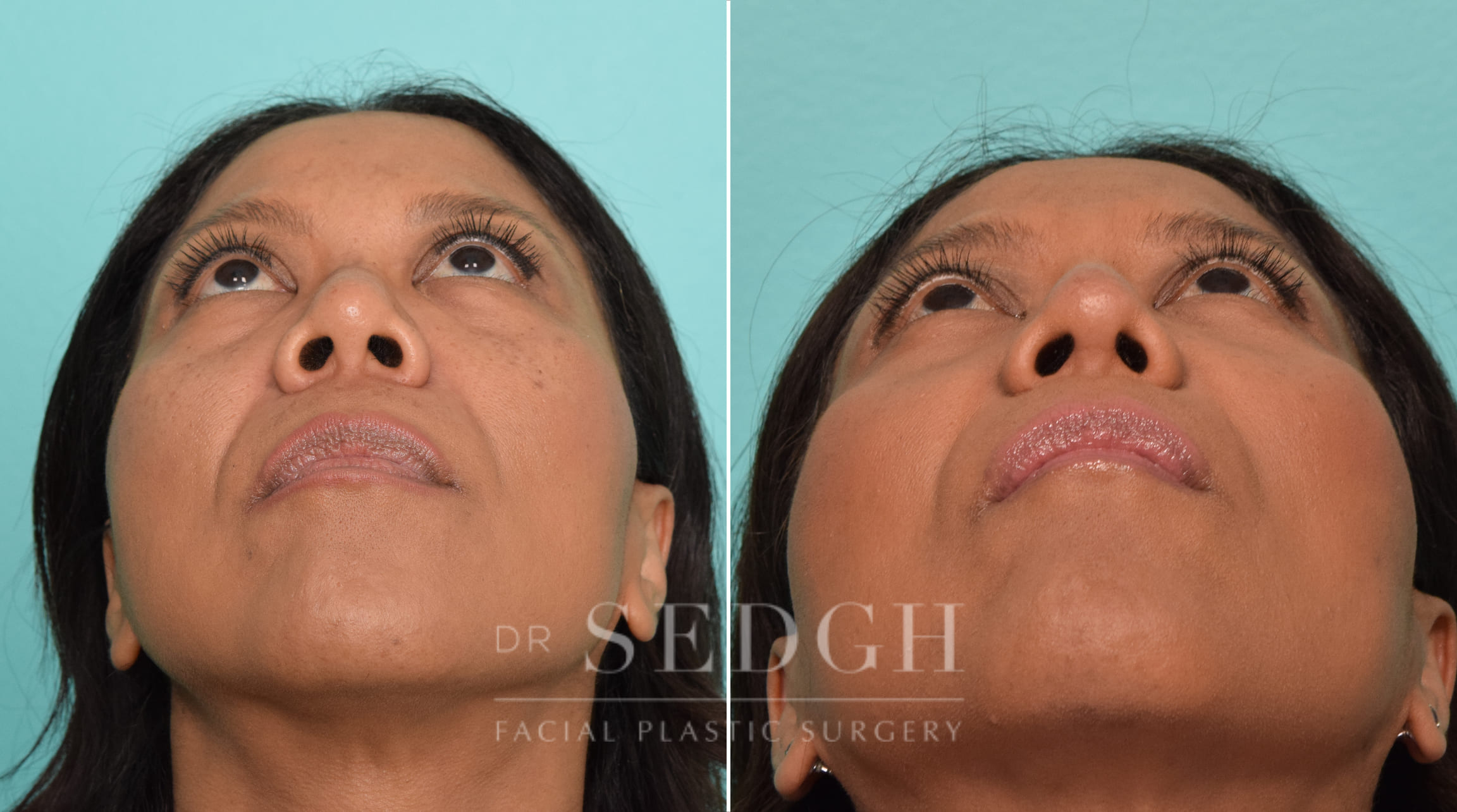 female patient before and after rhinoplasty | Sedgh