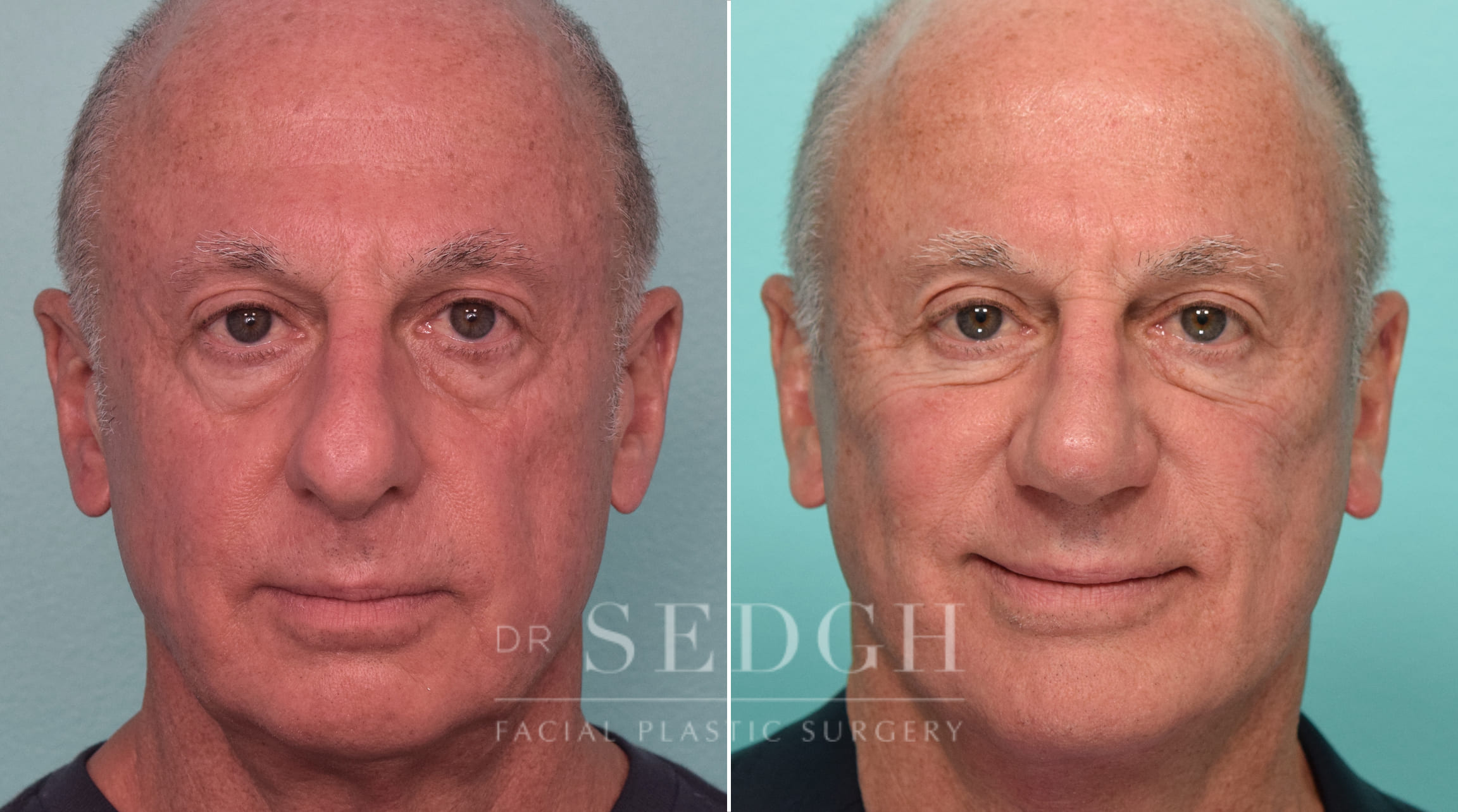 Facelift, Chin Augmentation and Rhinoplasty Before and After | Sedgh