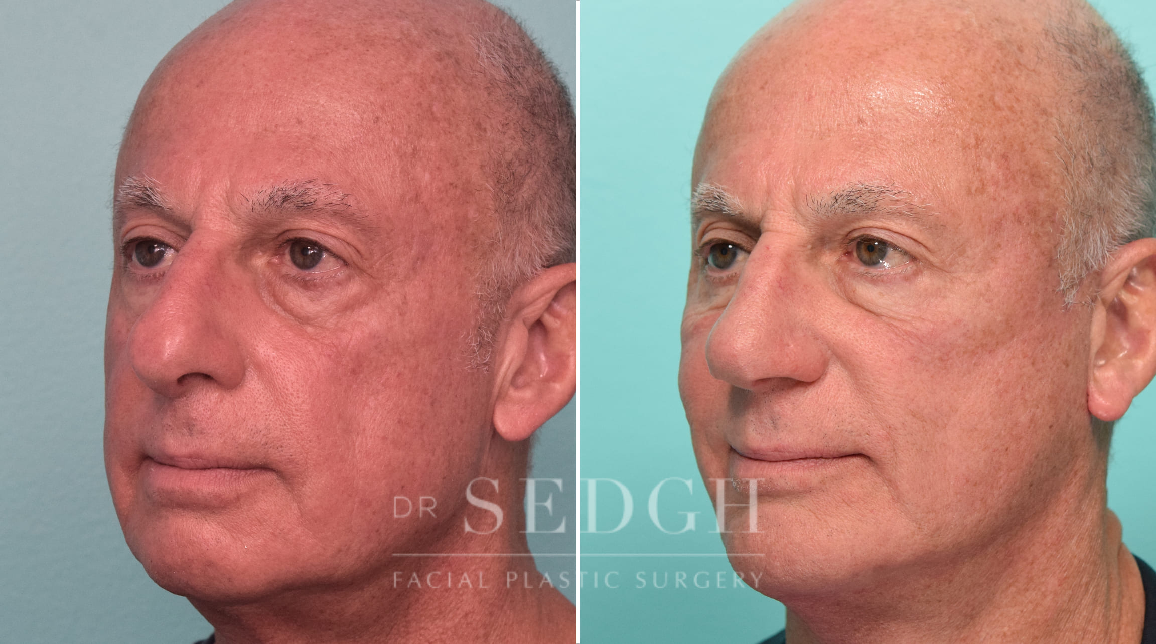 Facelift, Chin Augmentation and Rhinoplasty Before and After | Sedgh