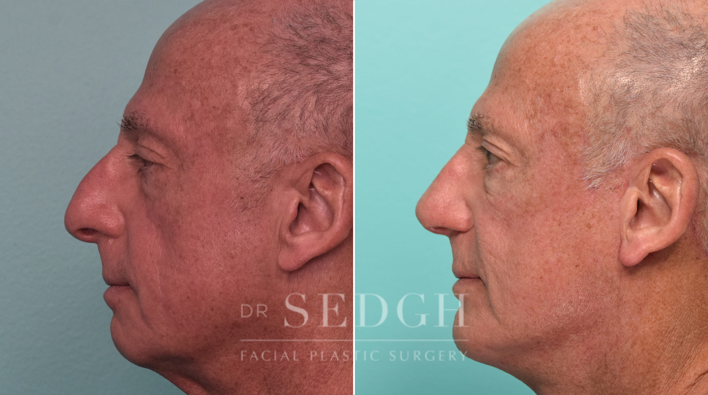 Facelift, Chin Augmentation and Rhinoplasty Before and After | Sedgh