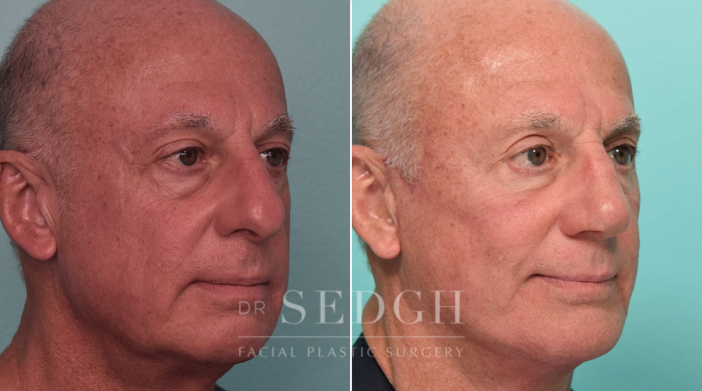 Facelift, Chin Augmentation and Rhinoplasty Before and After | Sedgh