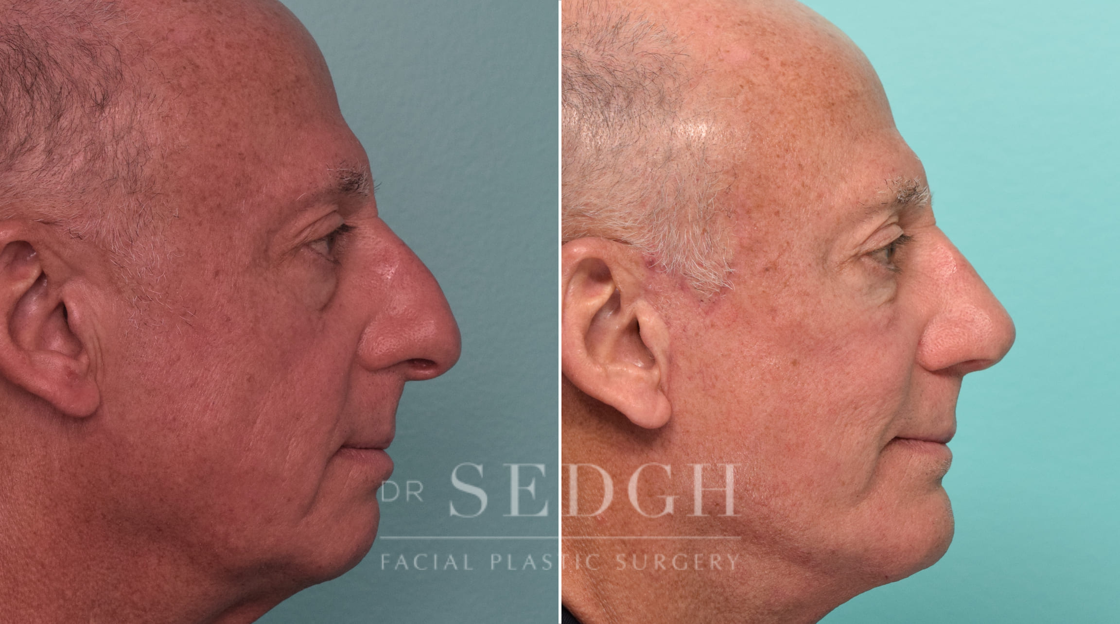 Facelift, Chin Augmentation and Rhinoplasty Before and After | Sedgh