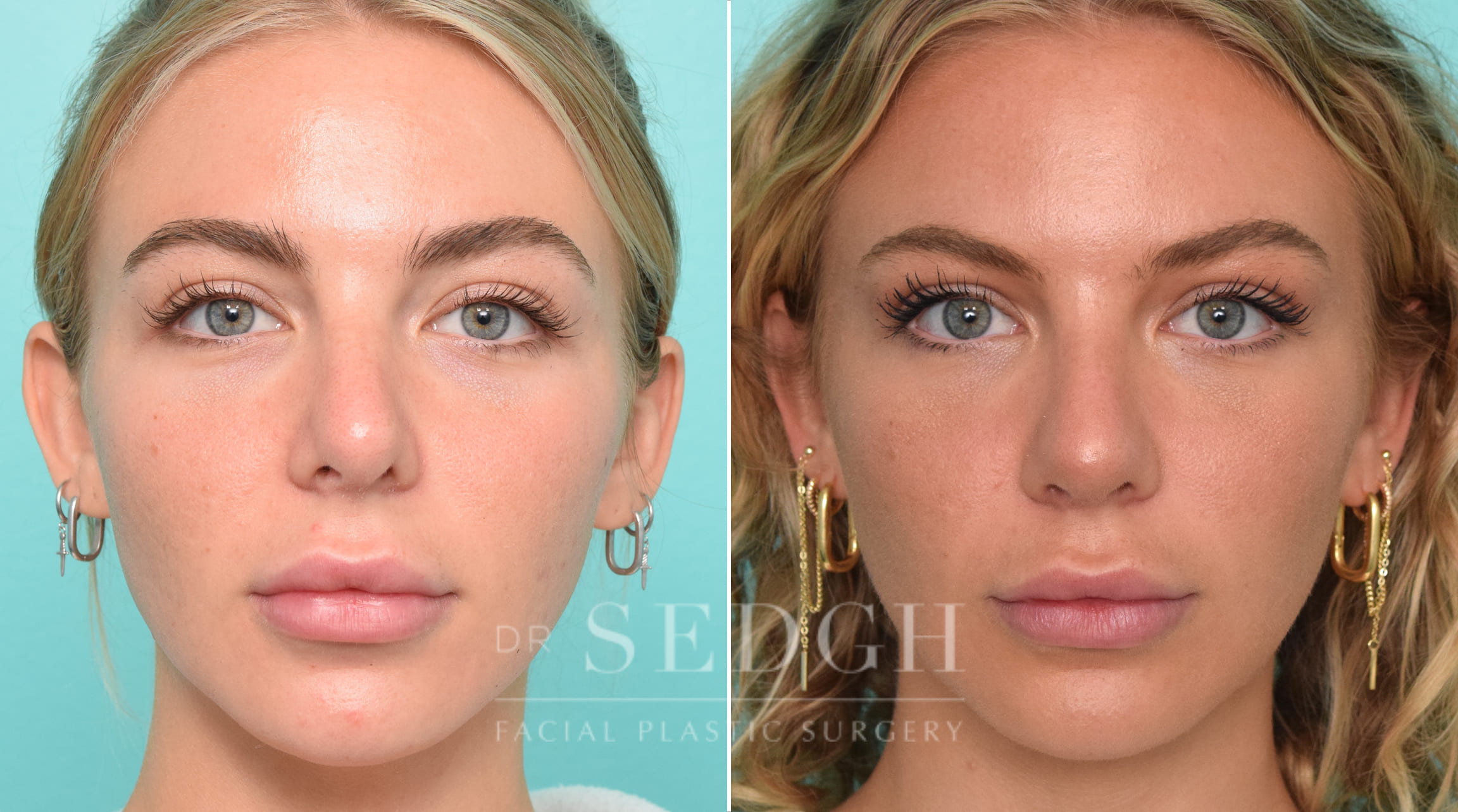 patient before and after revision rhinoplasty procedure