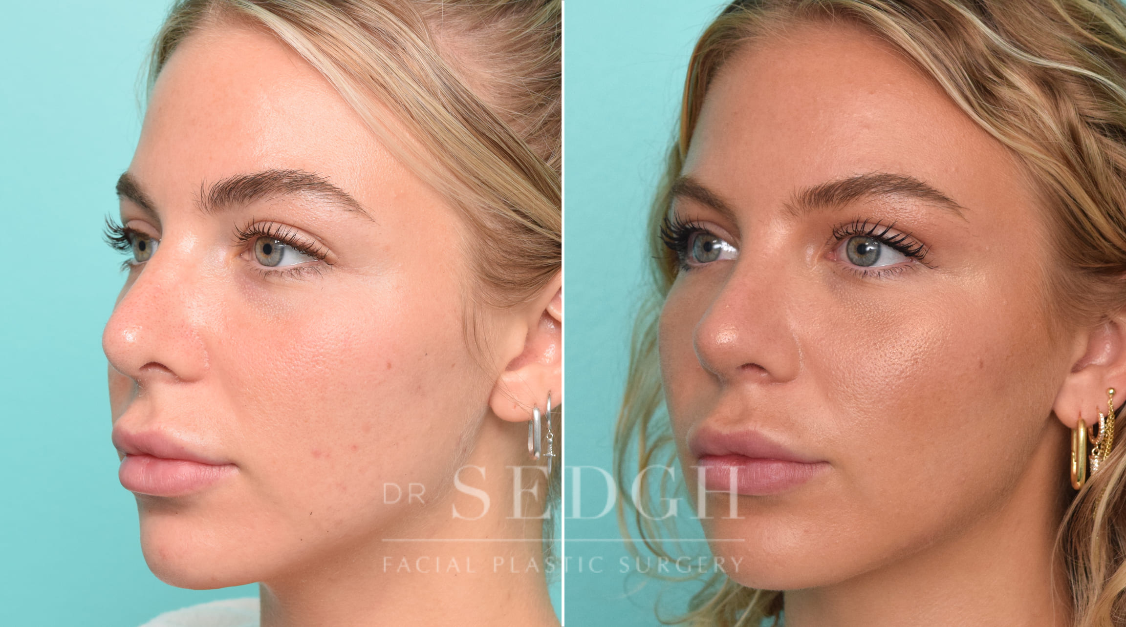 patient before and after revision rhinoplasty procedure