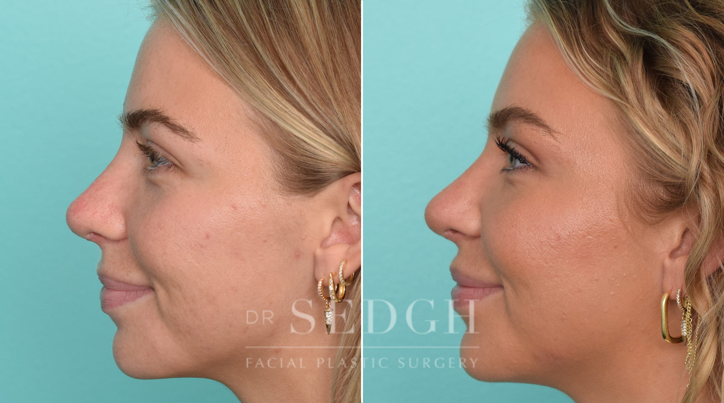 patient before and after revision rhinoplasty procedure