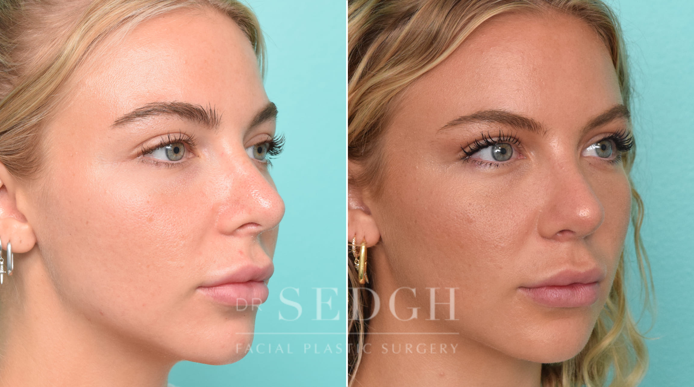 patient before and after revision rhinoplasty procedure