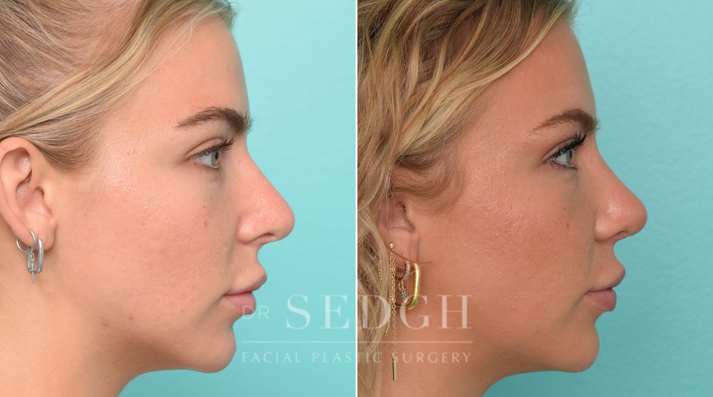 patient before and after revision rhinoplasty procedure