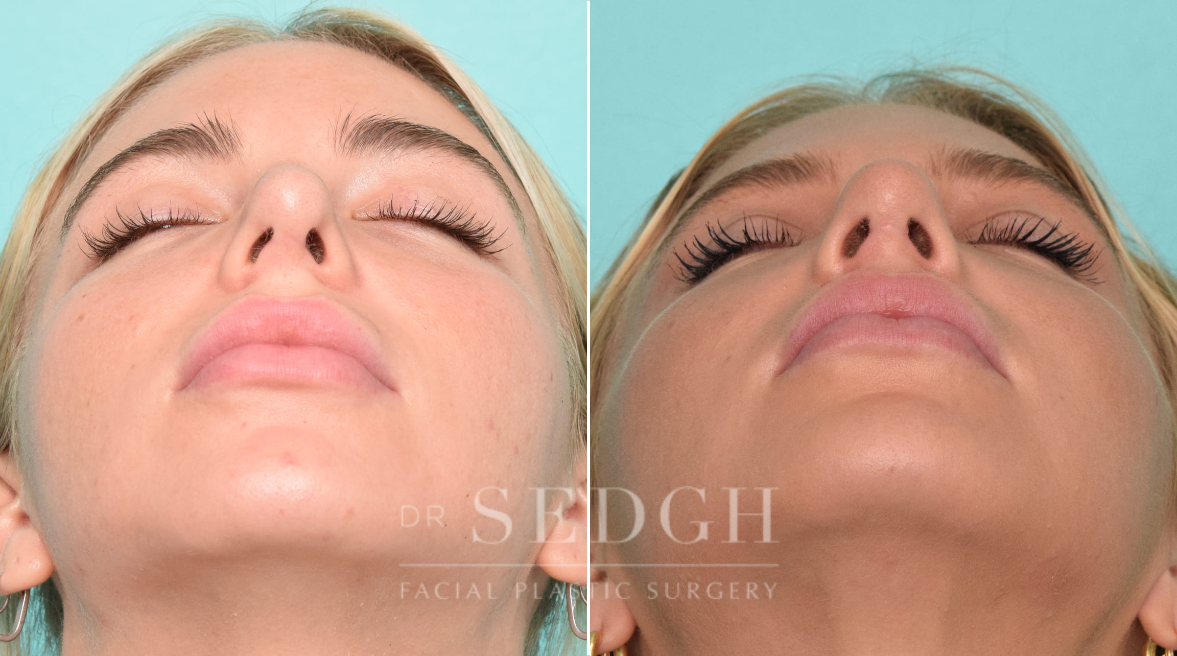 patient before and after revision rhinoplasty procedure