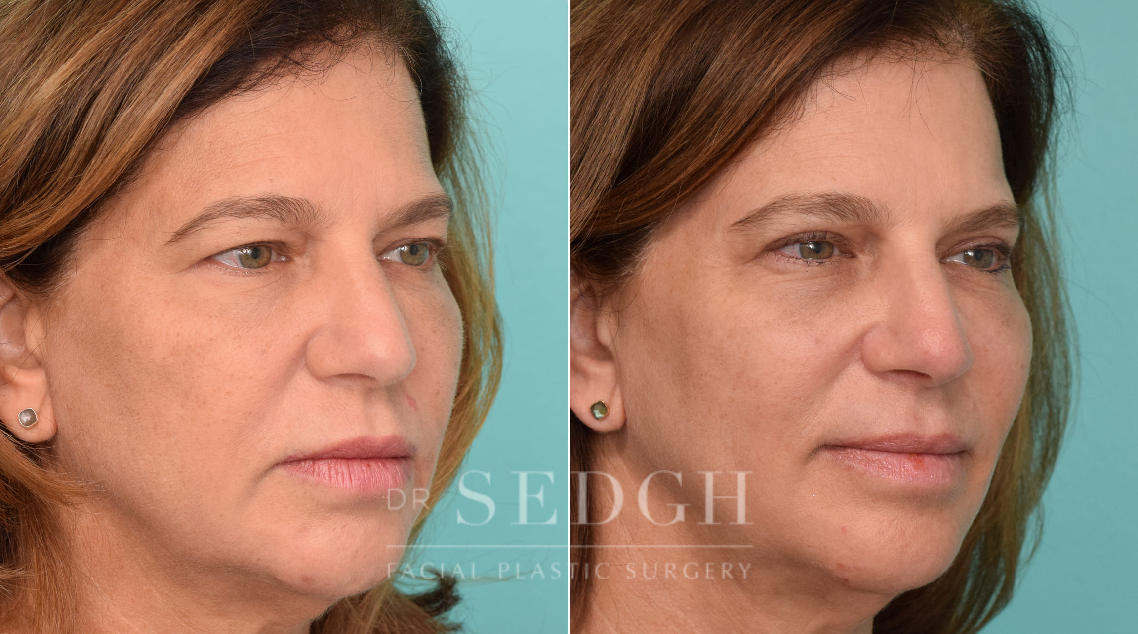 Female Patient Before and After Brow Lift | Sedgh