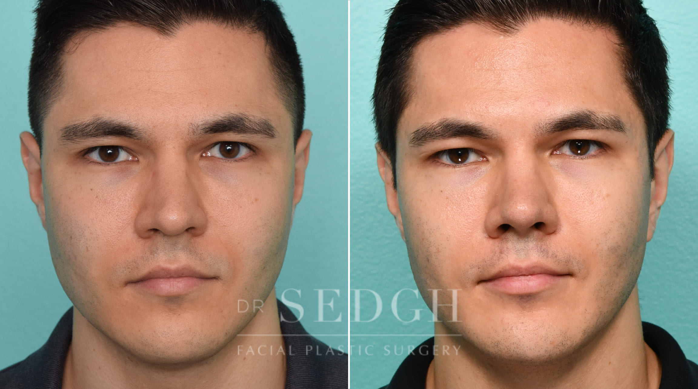 Male Patient Before and After Rhinoplasty, FaceTite and Chin Augmentation | Sedgh