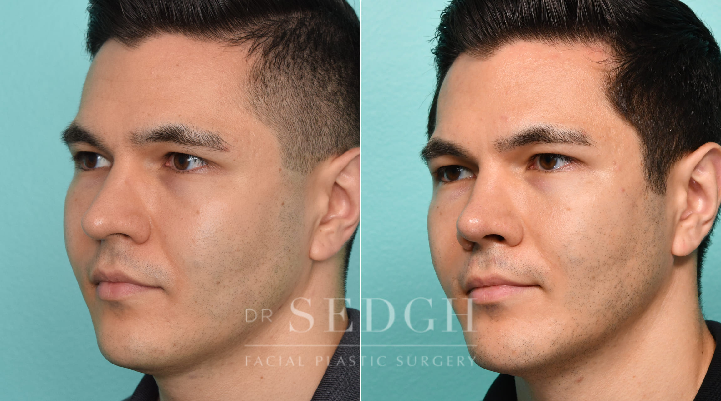 Male Patient Before and After Rhinoplasty, FaceTite and Chin Augmentation | Sedgh