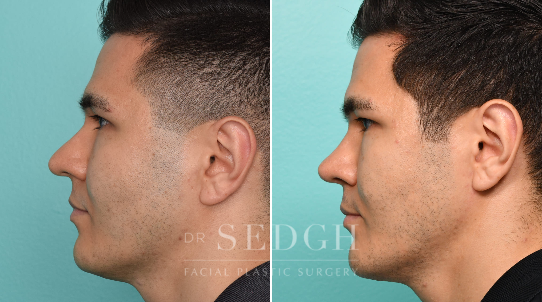 Male Patient Before and After Rhinoplasty, FaceTite and Chin Augmentation | Sedgh