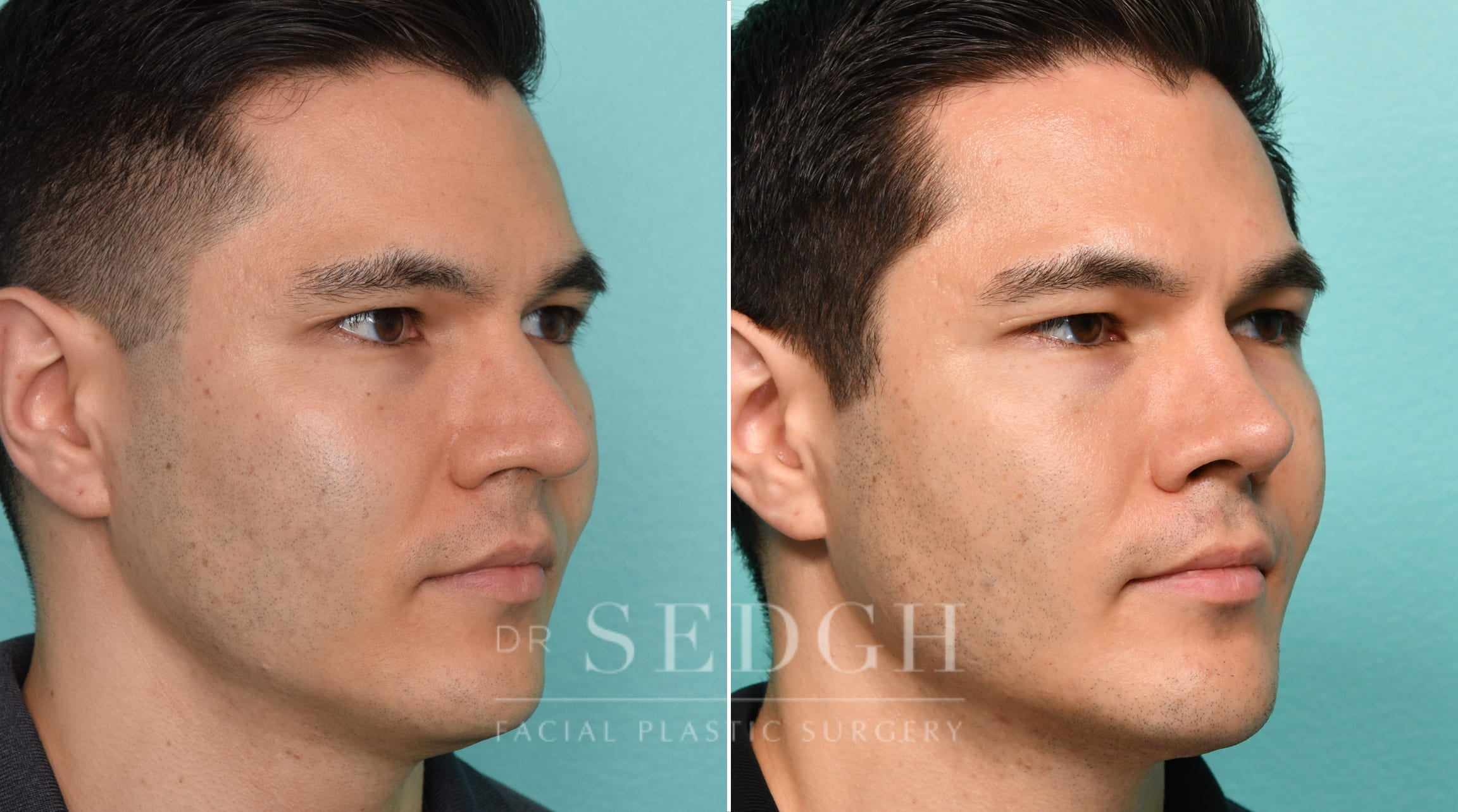 Male Patient Before and After Rhinoplasty, FaceTite and Chin Augmentation | Sedgh