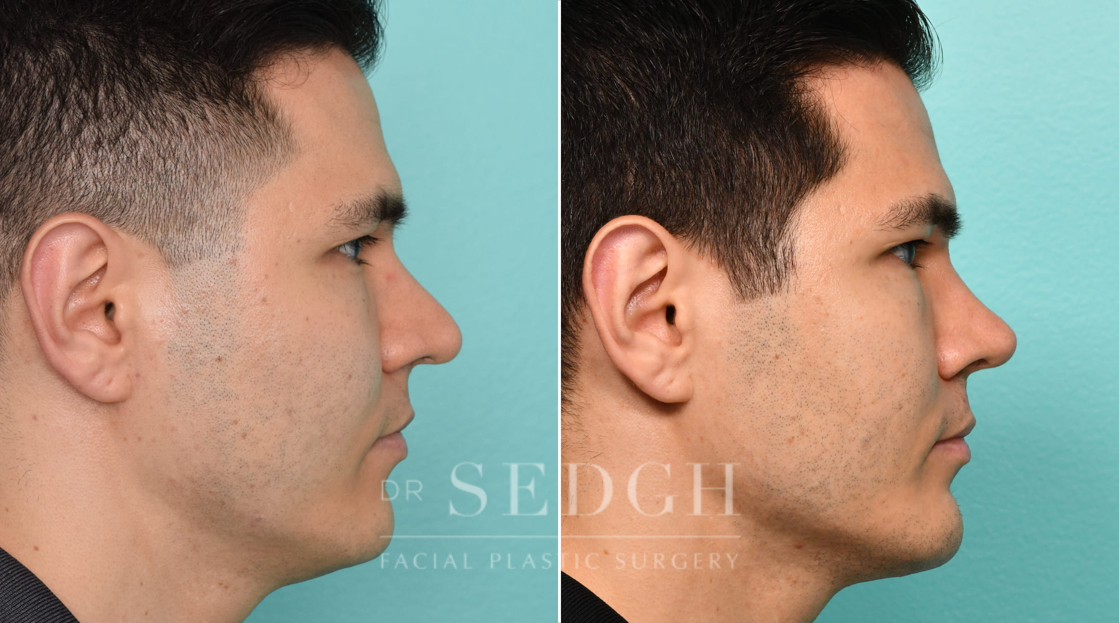 Male Patient Before and After Rhinoplasty, FaceTite and Chin Augmentation | Sedgh