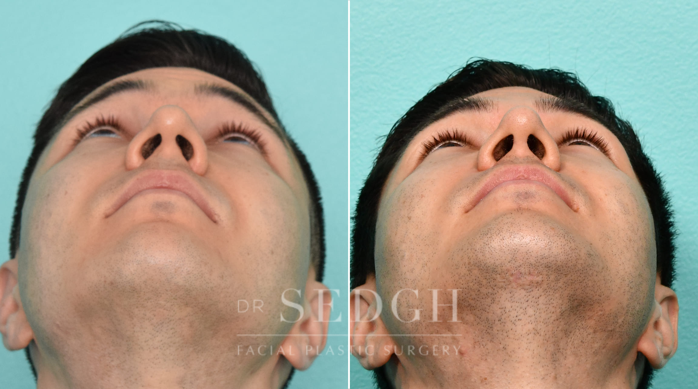 Male Patient Before and After Rhinoplasty, FaceTite and Chin Augmentation | Sedgh