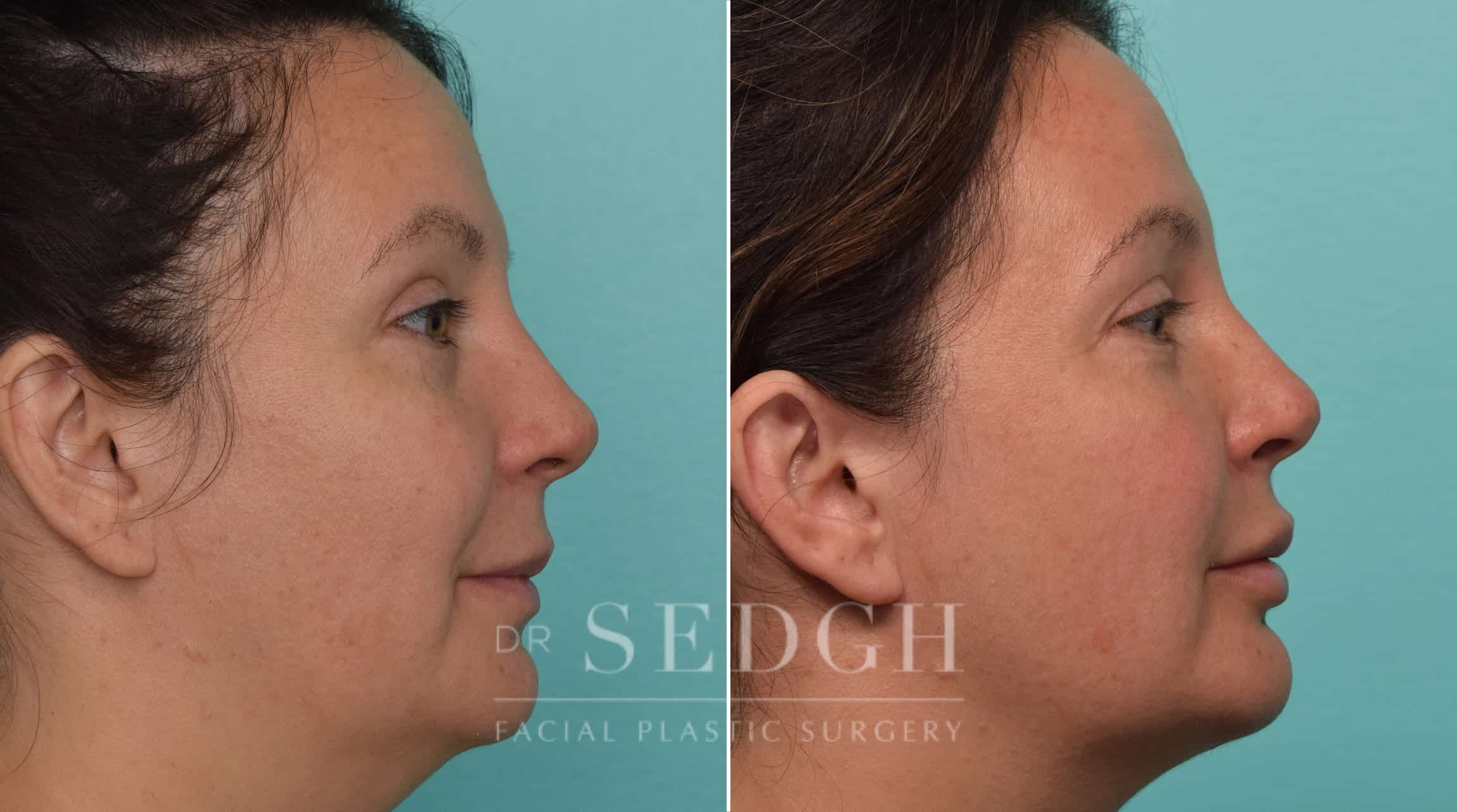 Female Patient Before and After Neck Lipo, FaceTite and Chin Augmentation | Sedgh