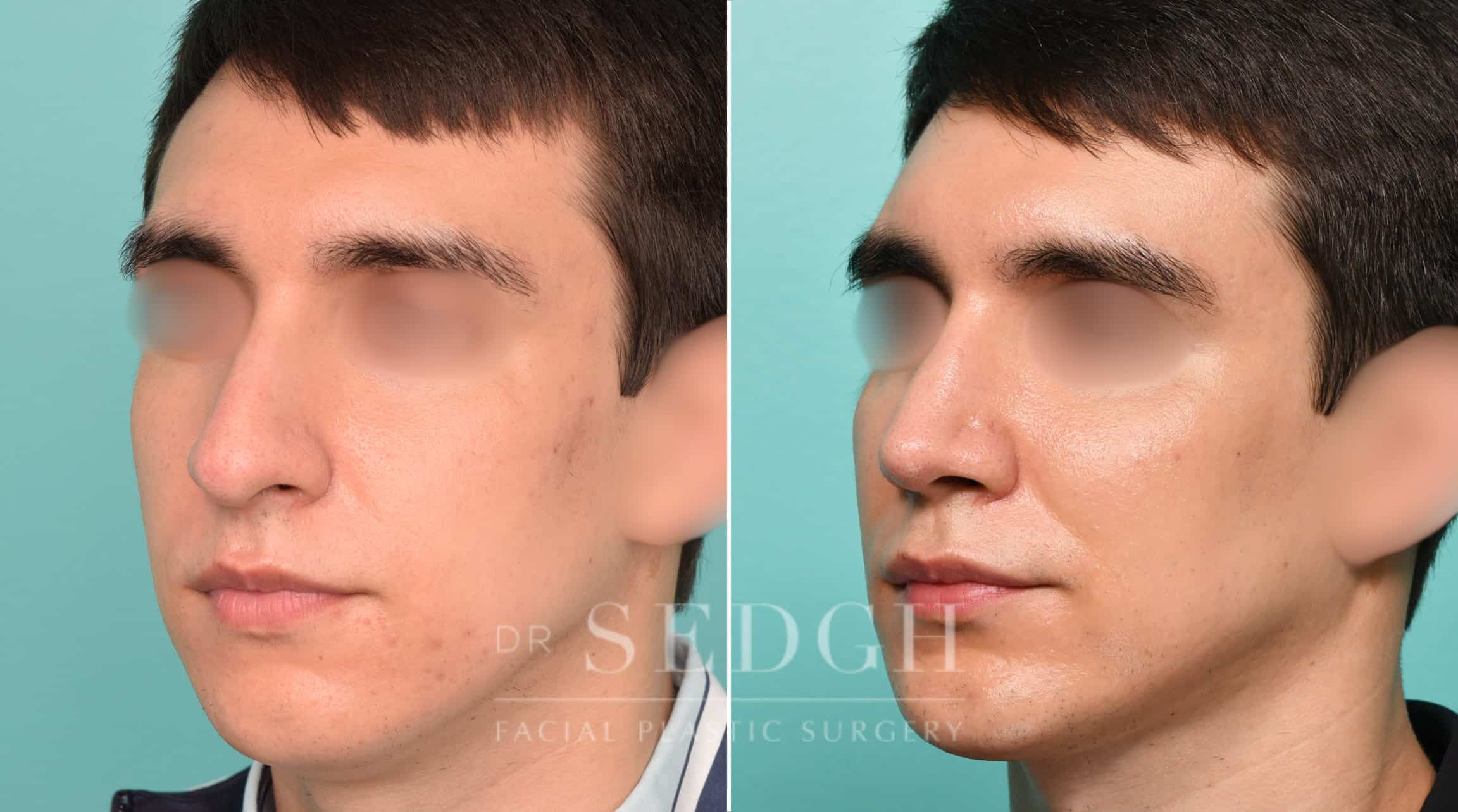 Male Patient Before and After Male Rhinoplasty, Chin Augmentation, and Facetite | Sedgh