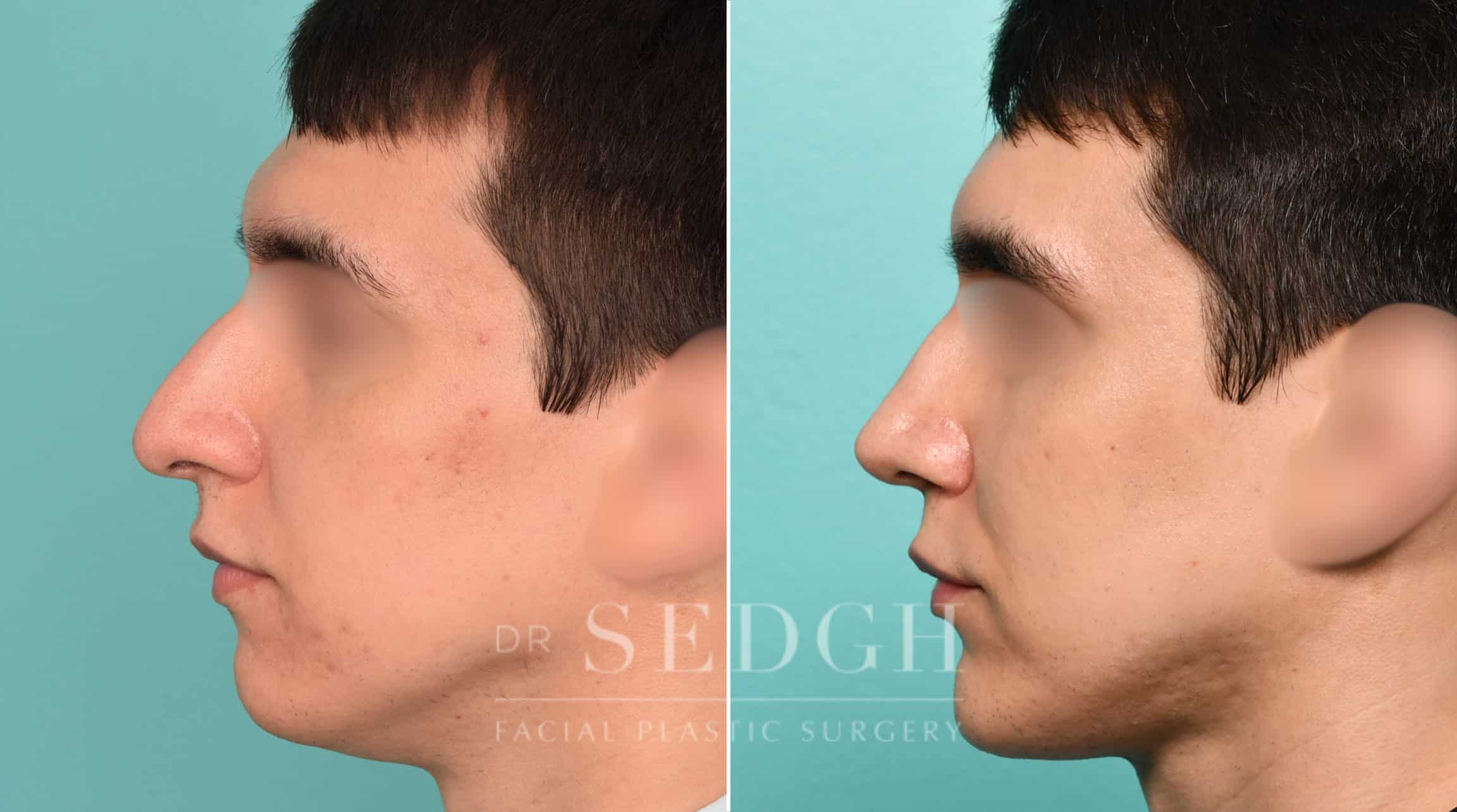 Male Patient Before and After Male Rhinoplasty, Chin Augmentation, and Facetite | Sedgh