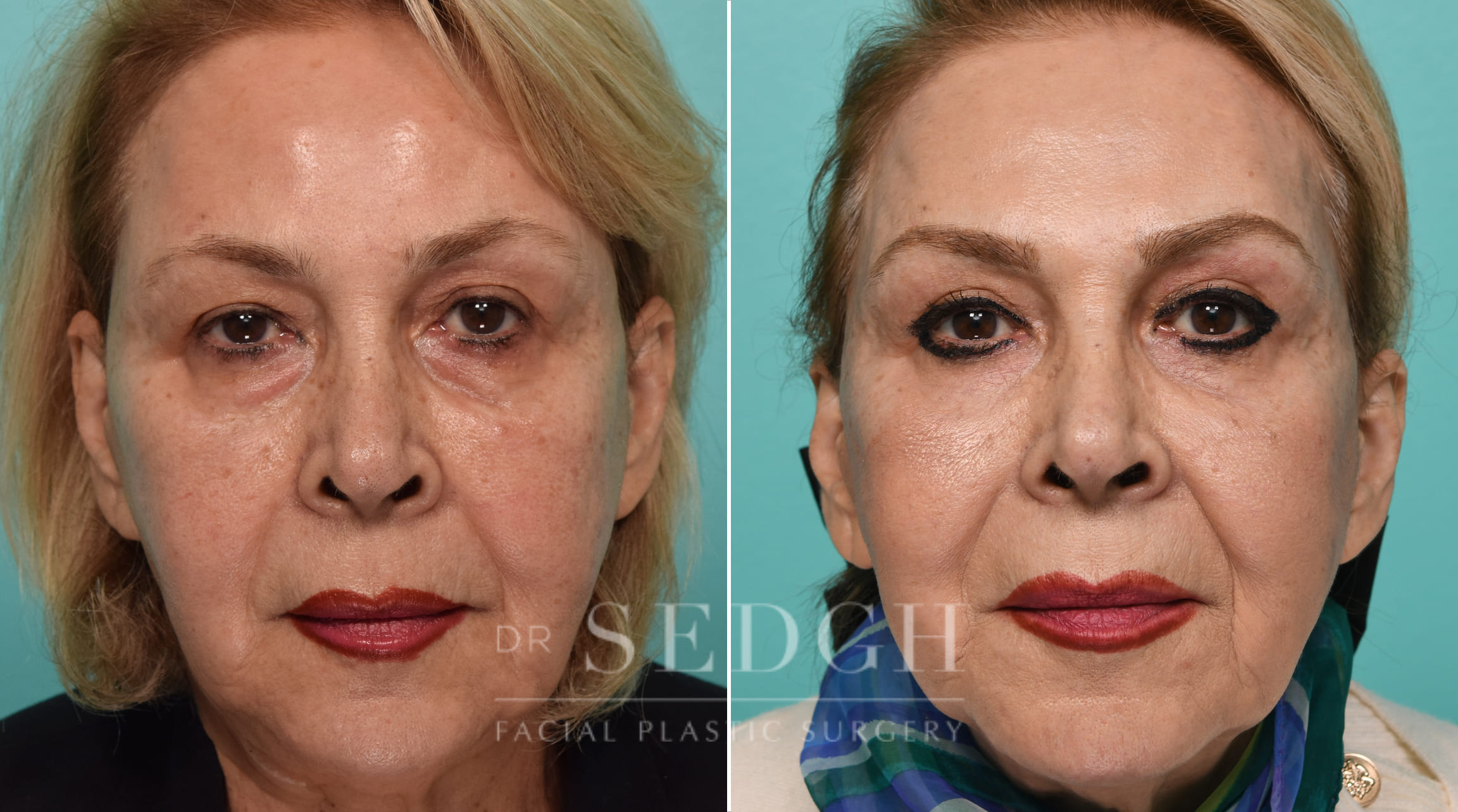 Female Patient Before and After Browlift and Upper Blepharoplasty | Sedgh