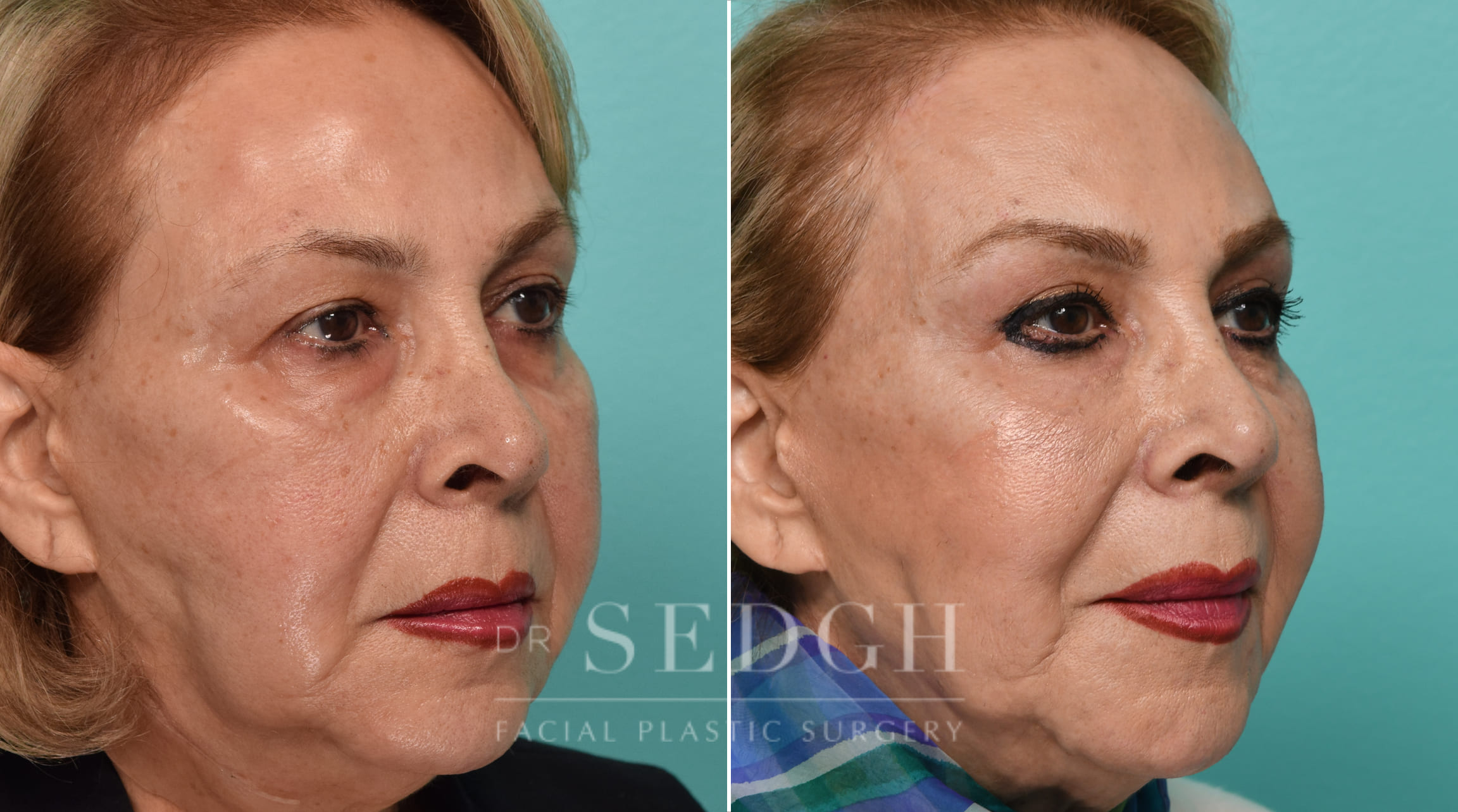 Female Patient Before and After Browlift and Upper Blepharoplasty | Sedgh