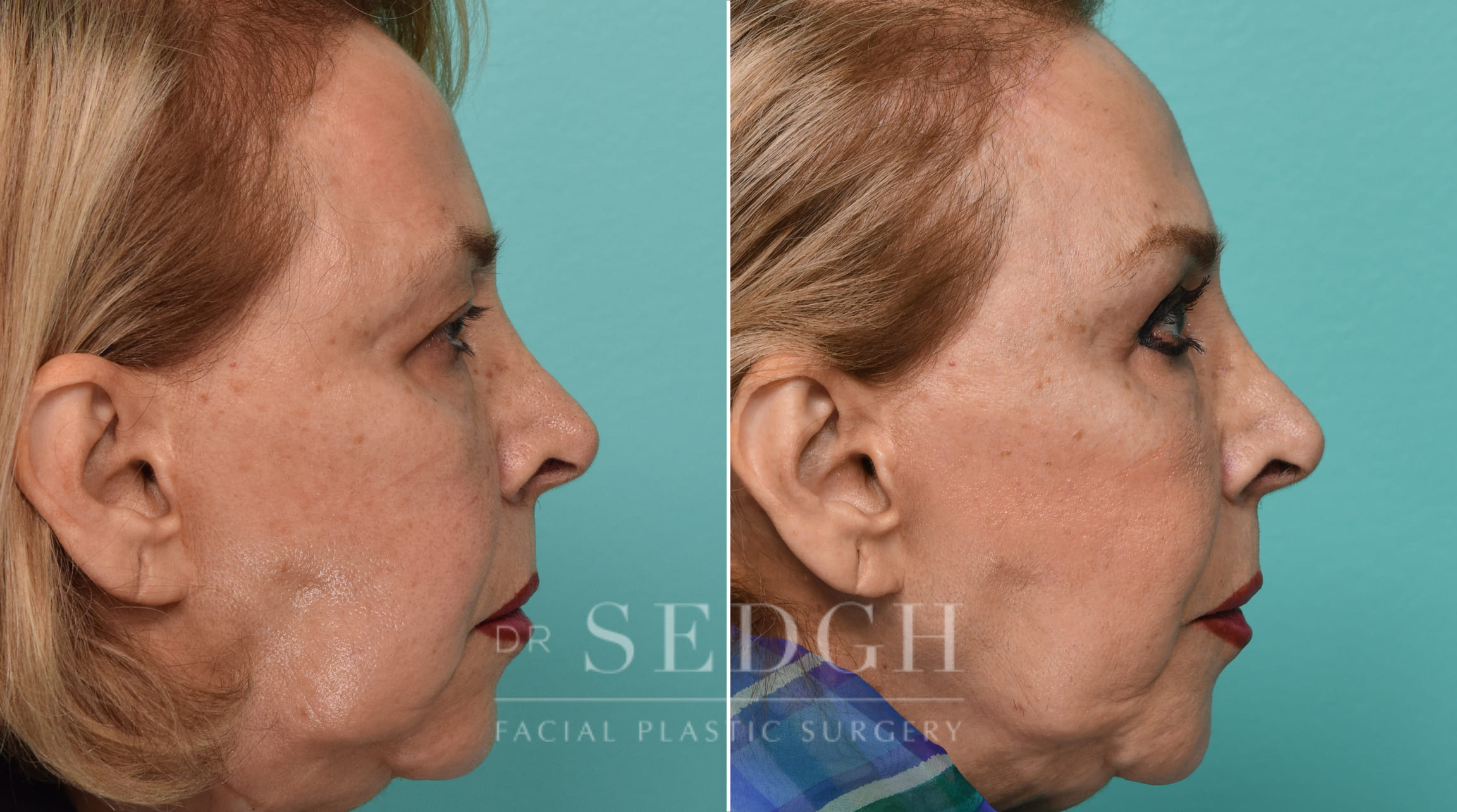 Female Patient Before and After Browlift and Upper Blepharoplasty | Sedgh