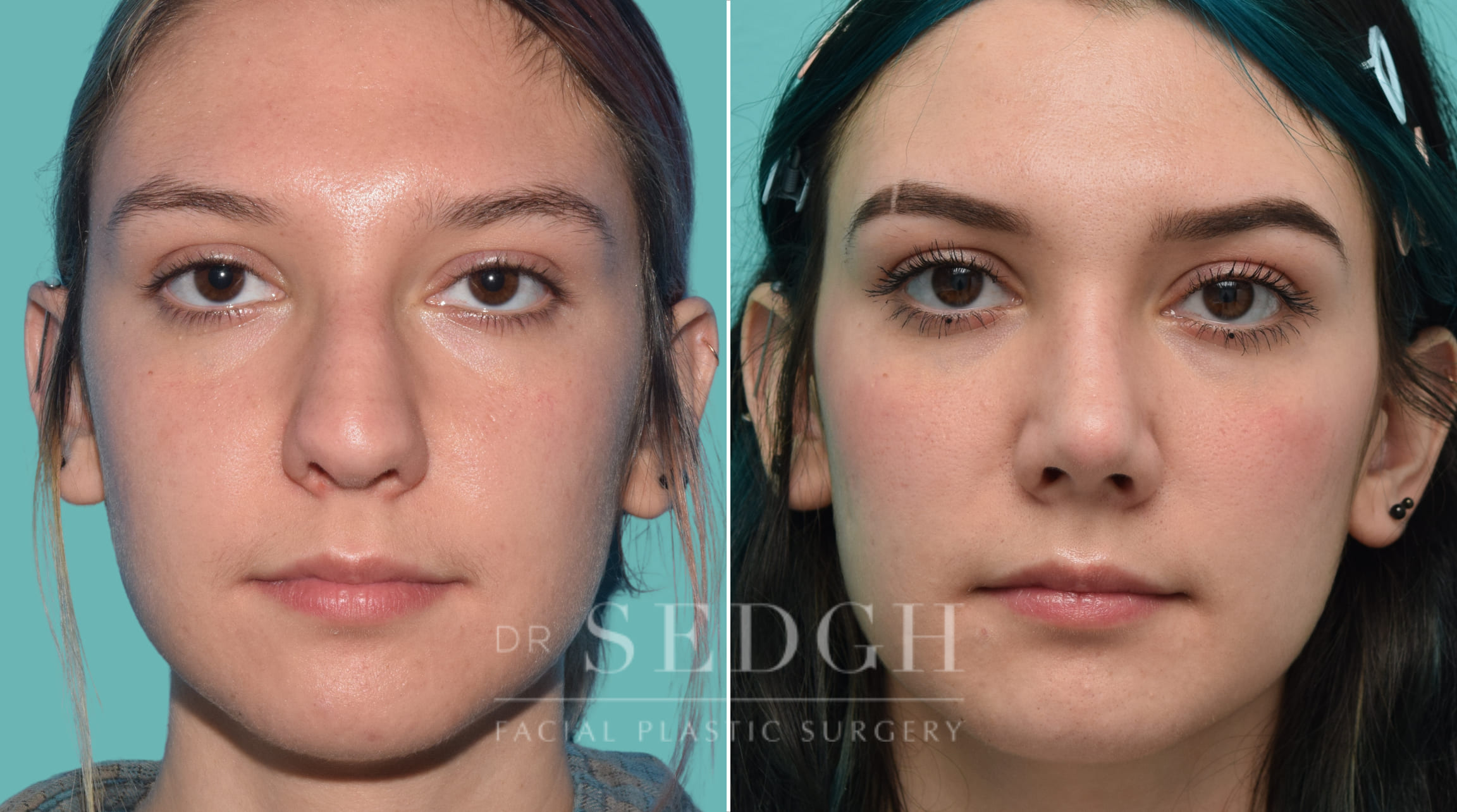 Rhinoplasty Before and After | Sedgh