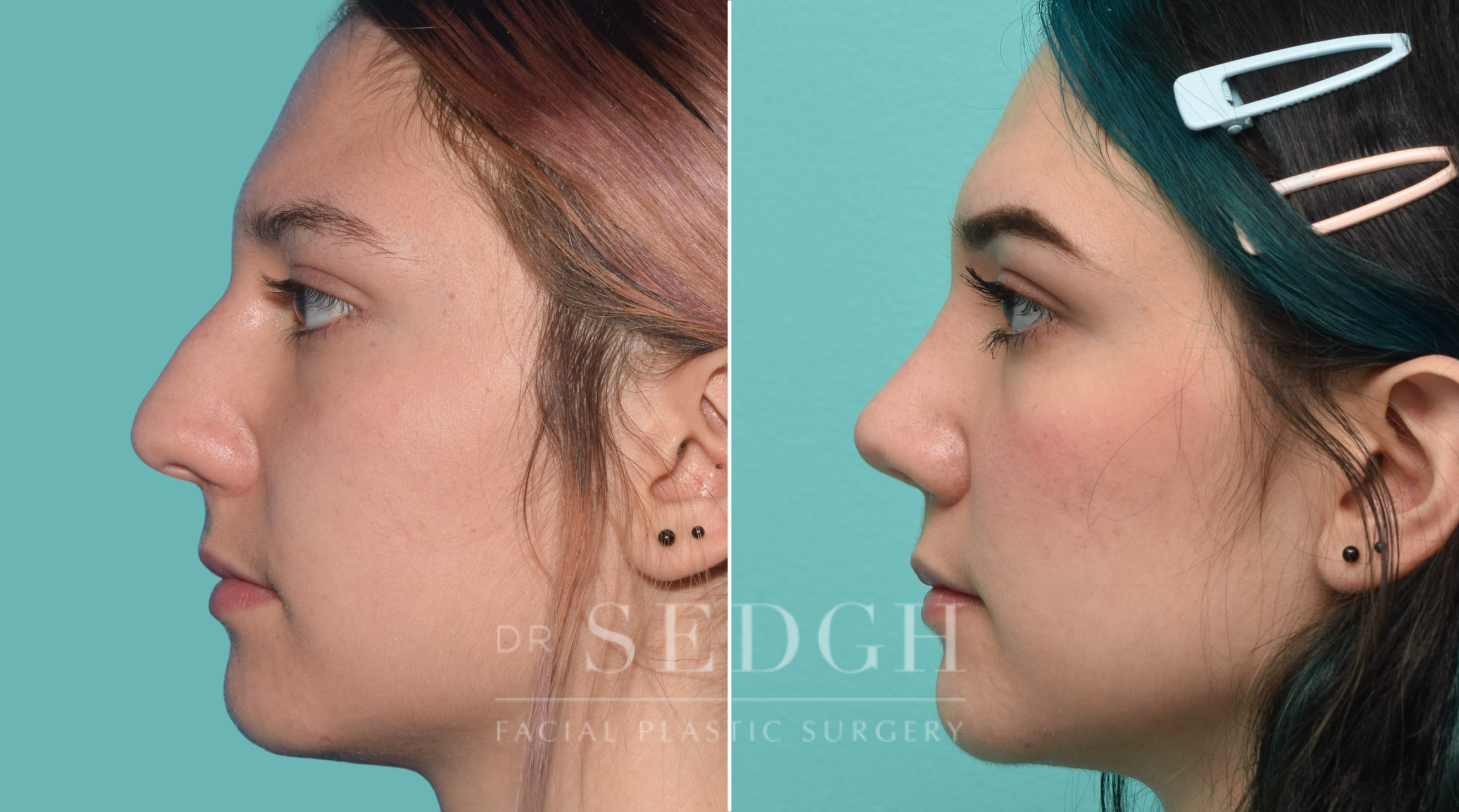 Rhinoplasty Before and After | Sedgh